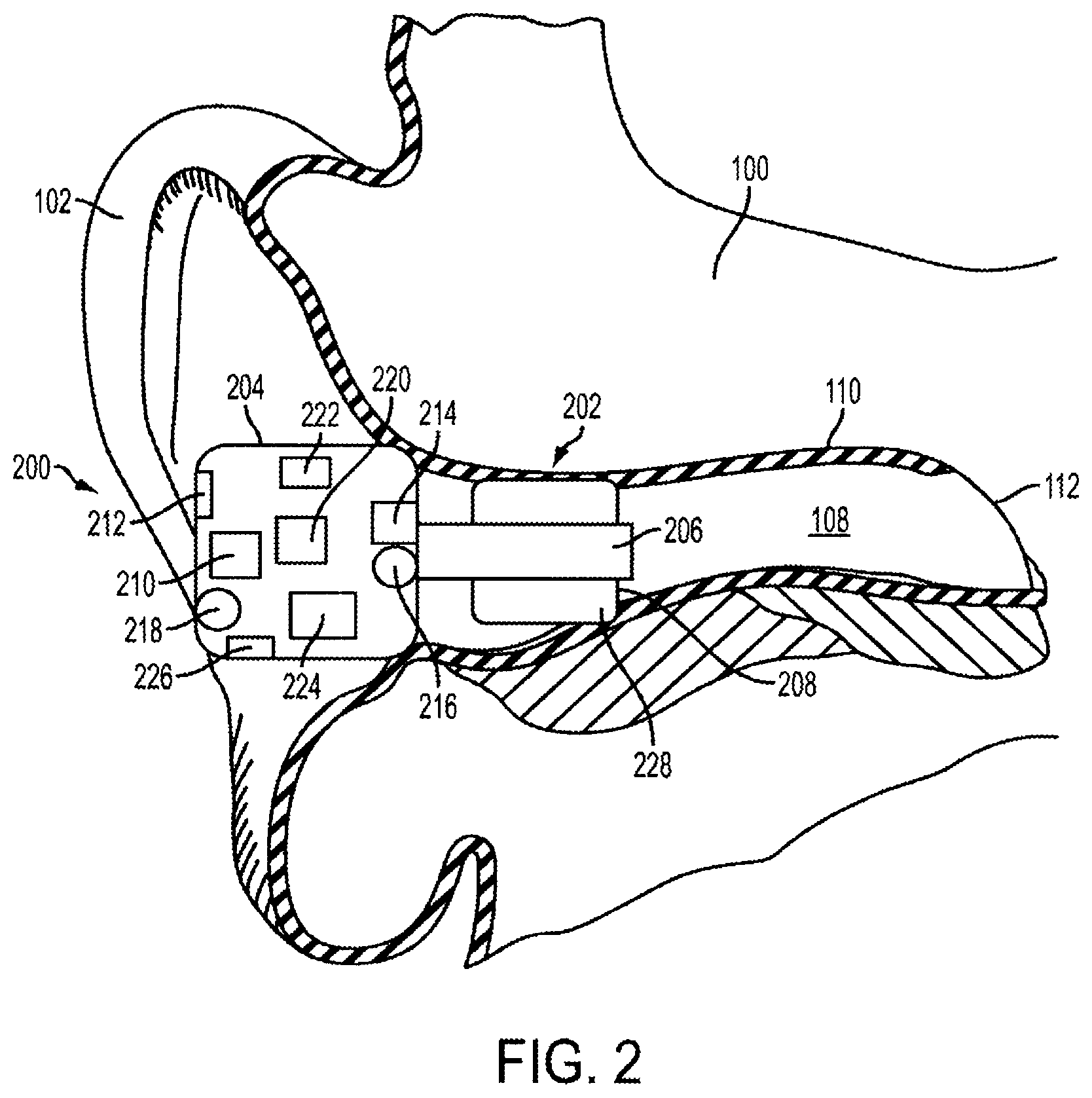 Patent US11832046 Figure 2 – Methods and devices for occluding an ear canal having a predetermined filter characteristic