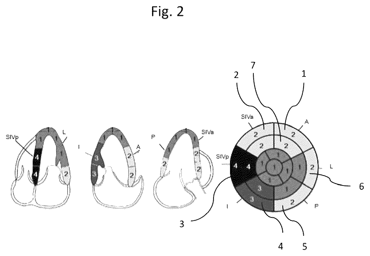 Patent US11836921 Figure 3 – Artificial-intelligence-based global cardiac motion classification