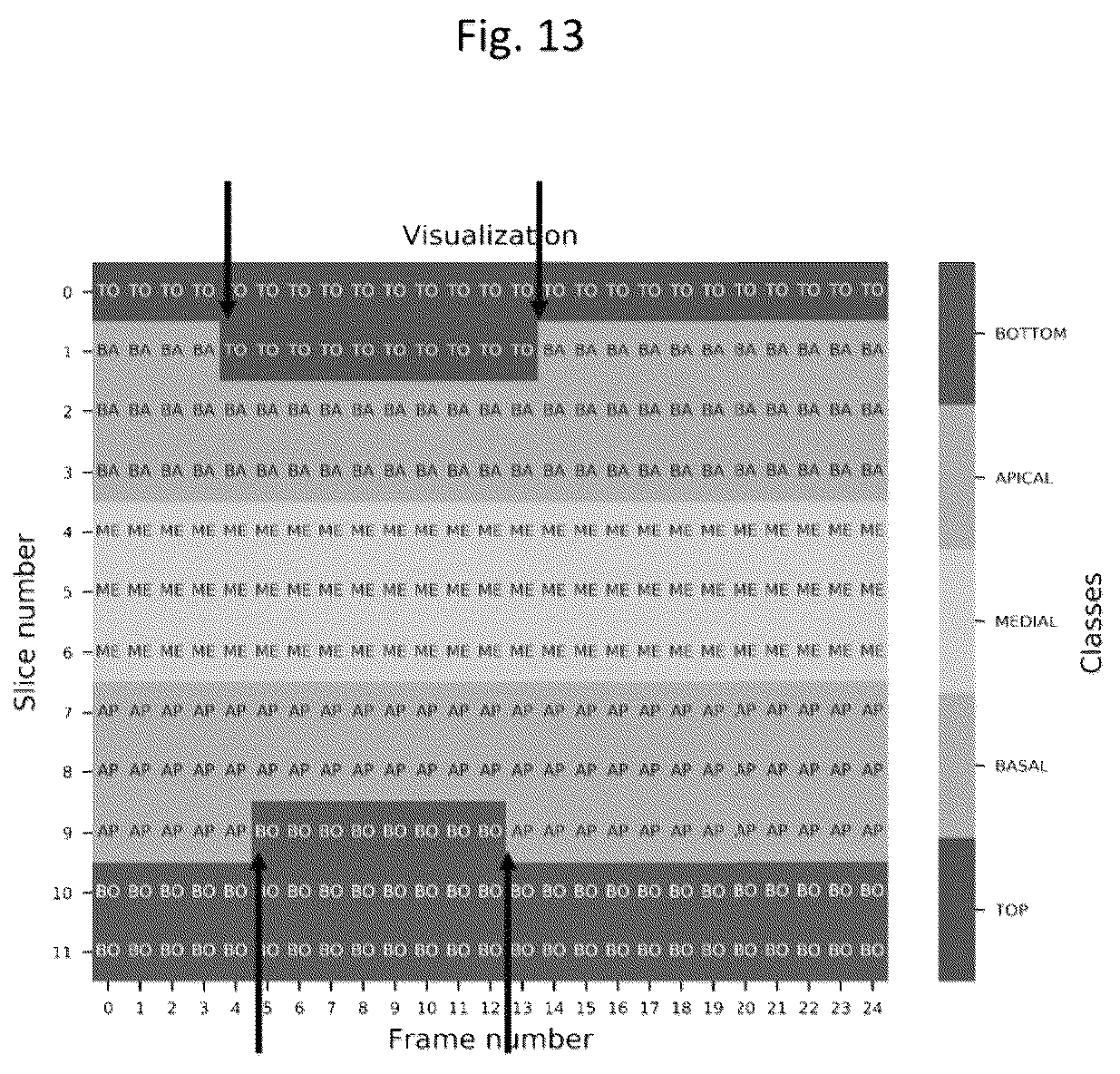 Patent US11836921 Figure 13 – Artificial-intelligence-based global cardiac motion classification