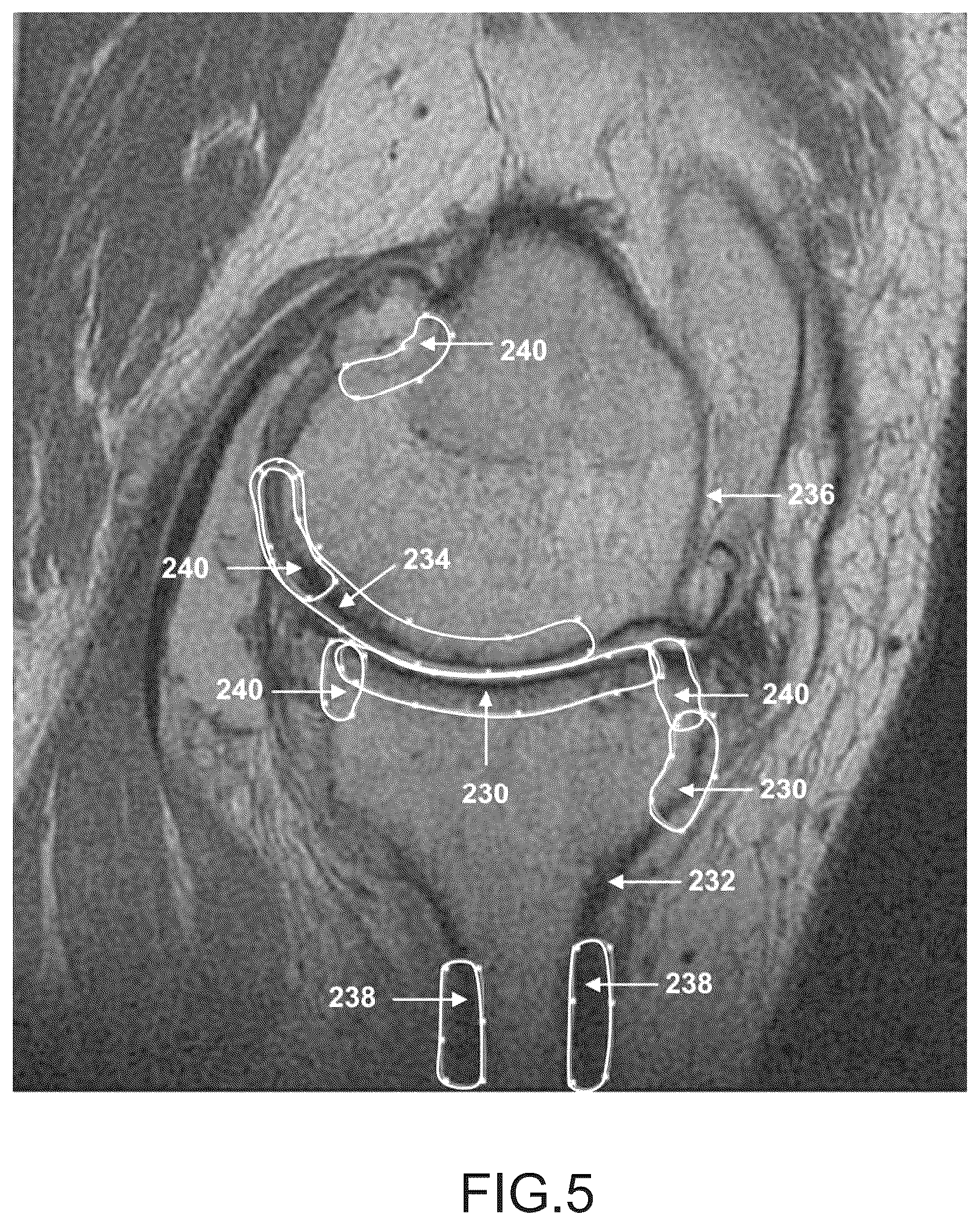 Patent US11847755 Figure 16 – System and method for image segmentation, bone model generation and modification, and surgical planning