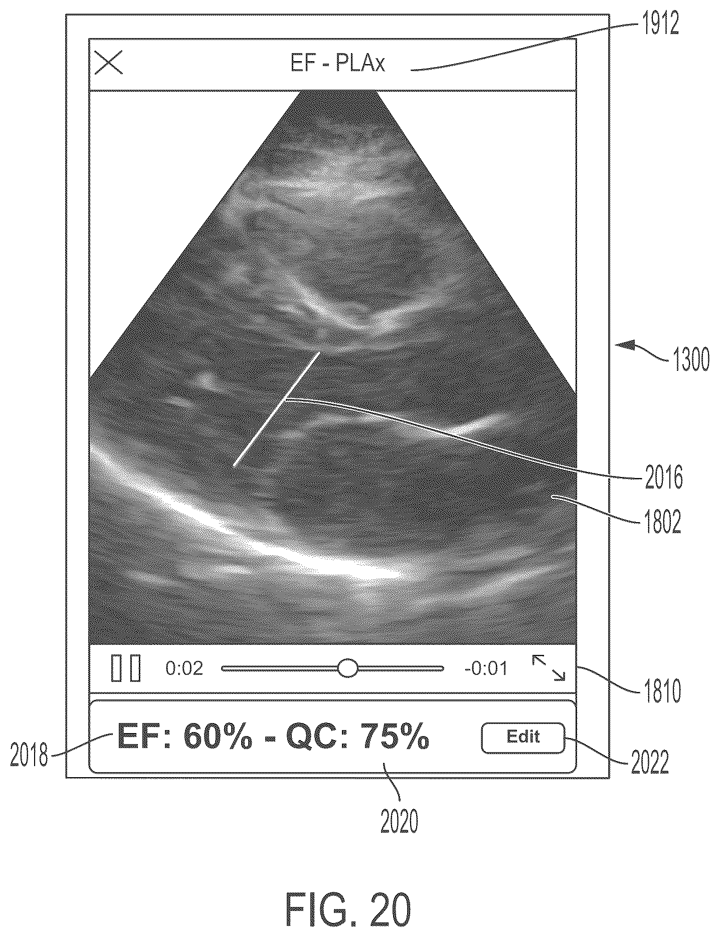 Patent US11847772 Figure 20 – Quality indicators for collection of and automated measurement on ultrasound images