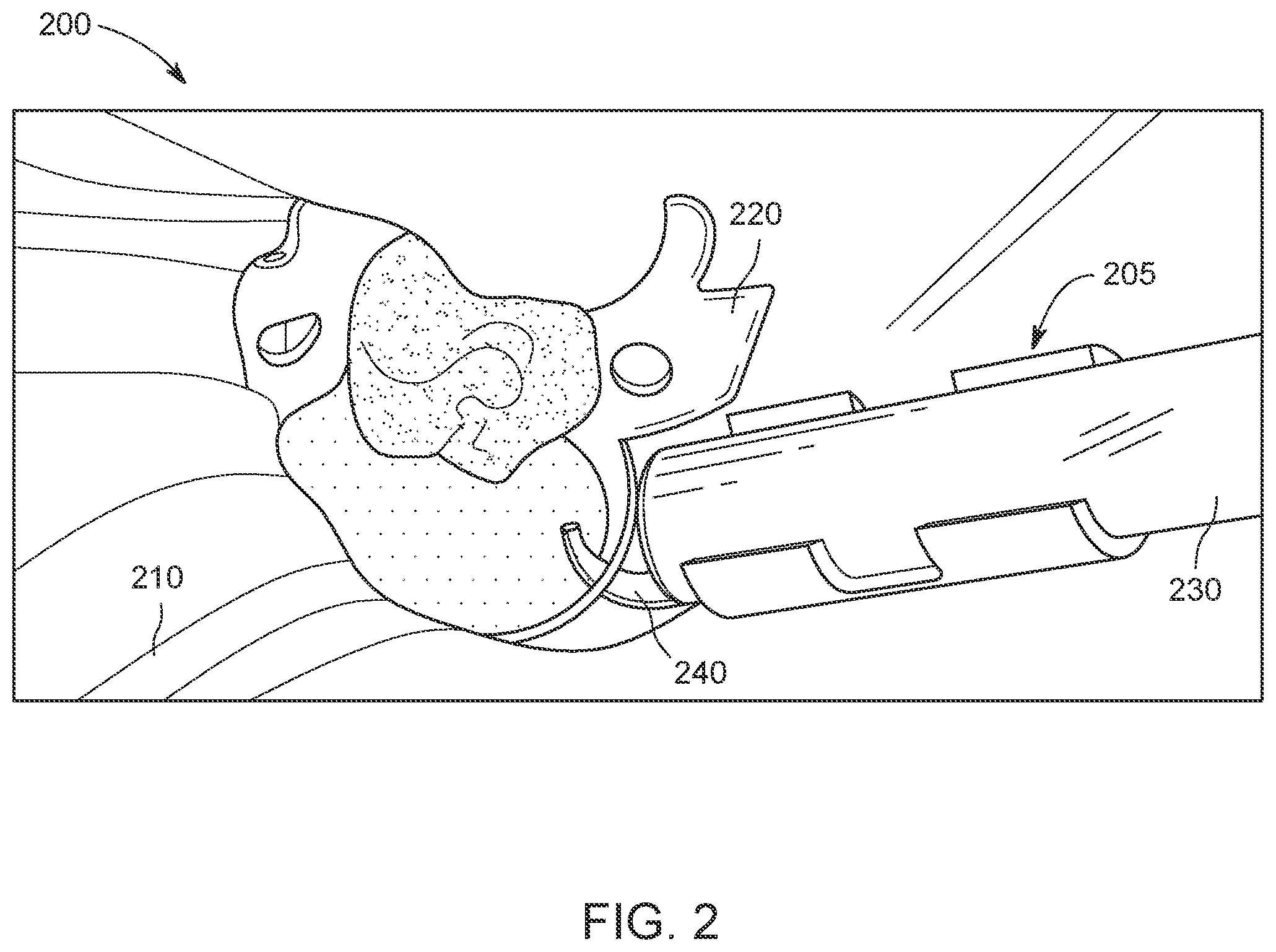 Patent US12090012 Figure 2 – Apparatus for suction tube positioning