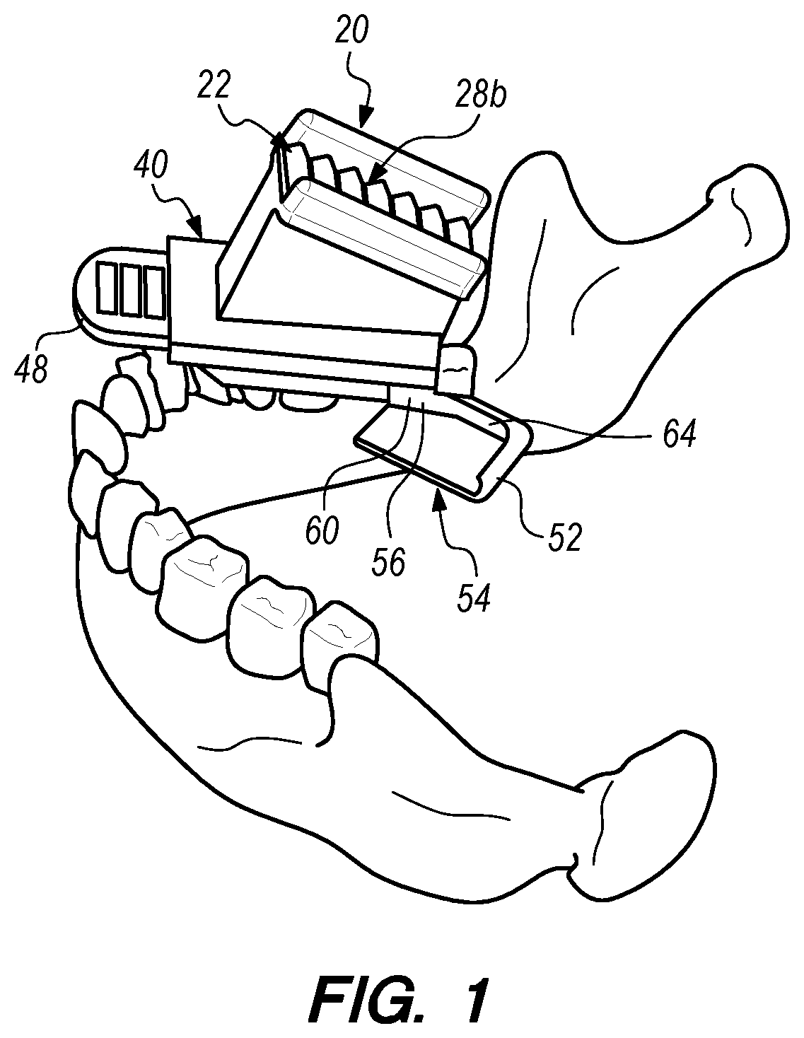 Patent US12090019 Figure 1 – Bite block with a needle alignment attachment system