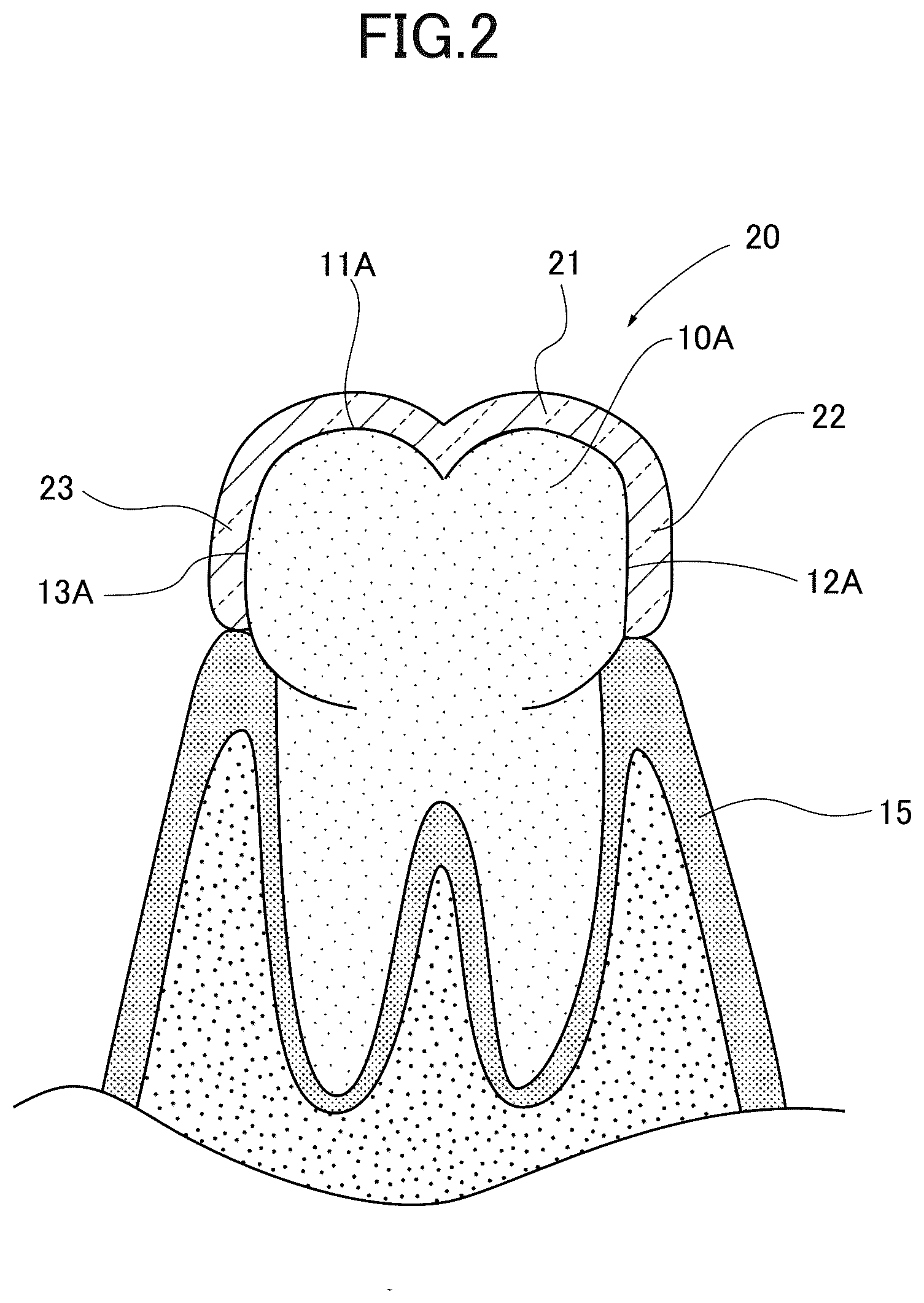 Patent US12090022 Figure 2 – Mouthpiece and mouthpiece manufacturing method