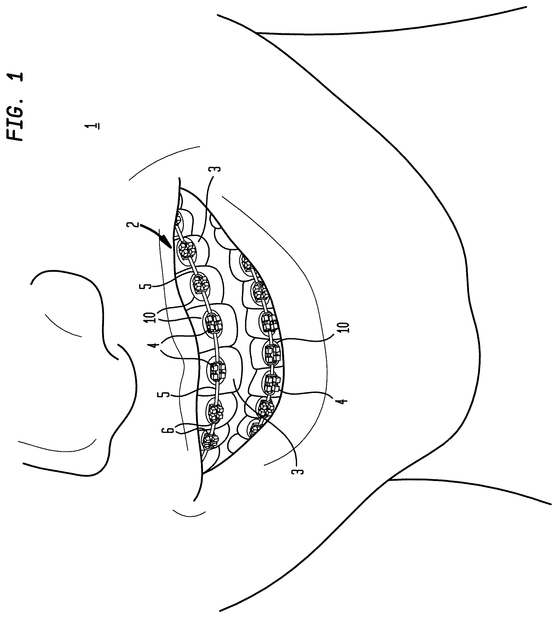 Patent US12090024 Figure 1 – Bracket system