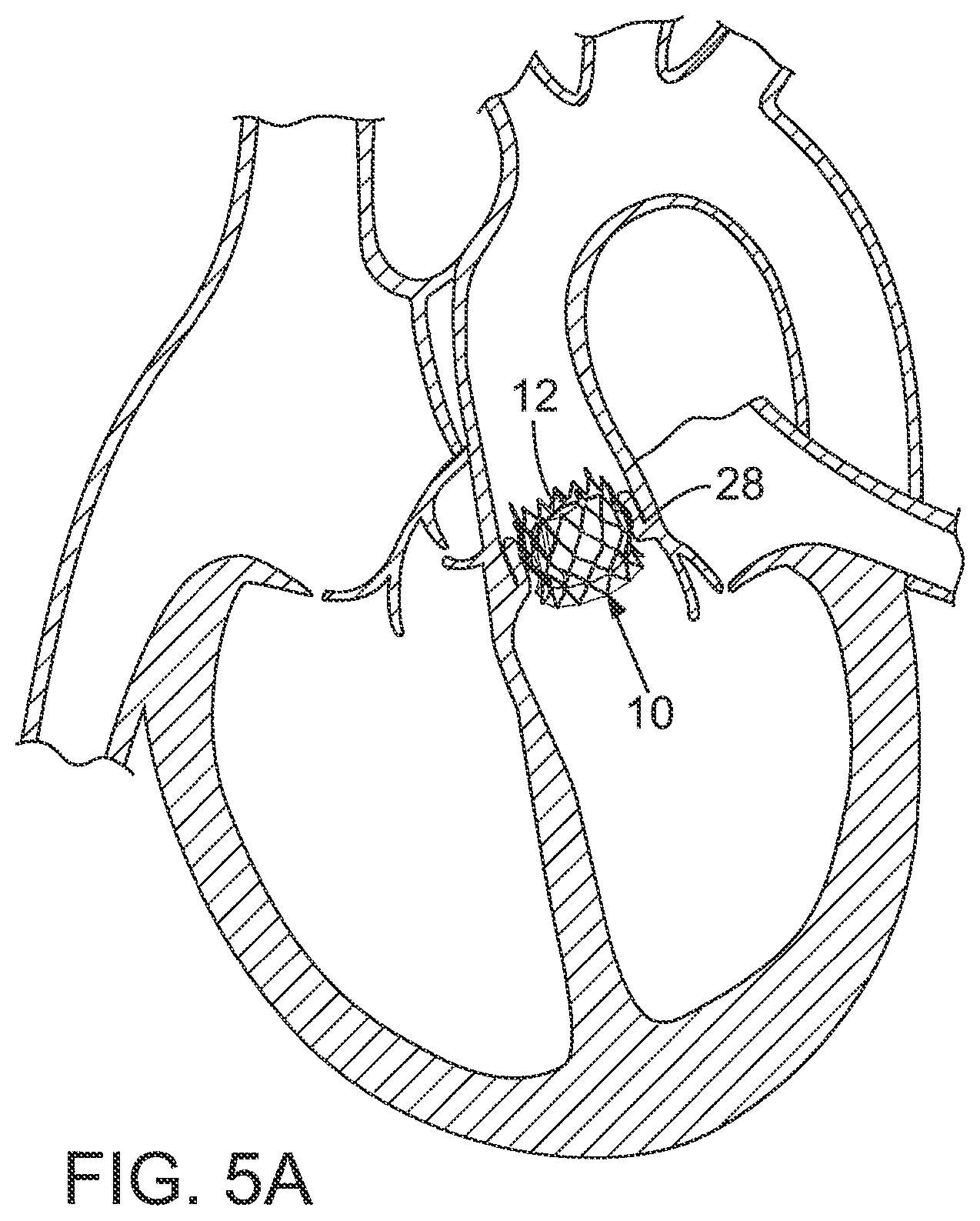 Patent US12090036 Figure 3 – Storage assembly for prosthetic valve
