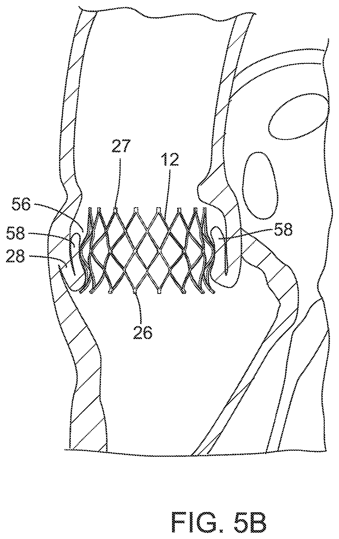 Patent US12090036 Figure 4 – Storage assembly for prosthetic valve