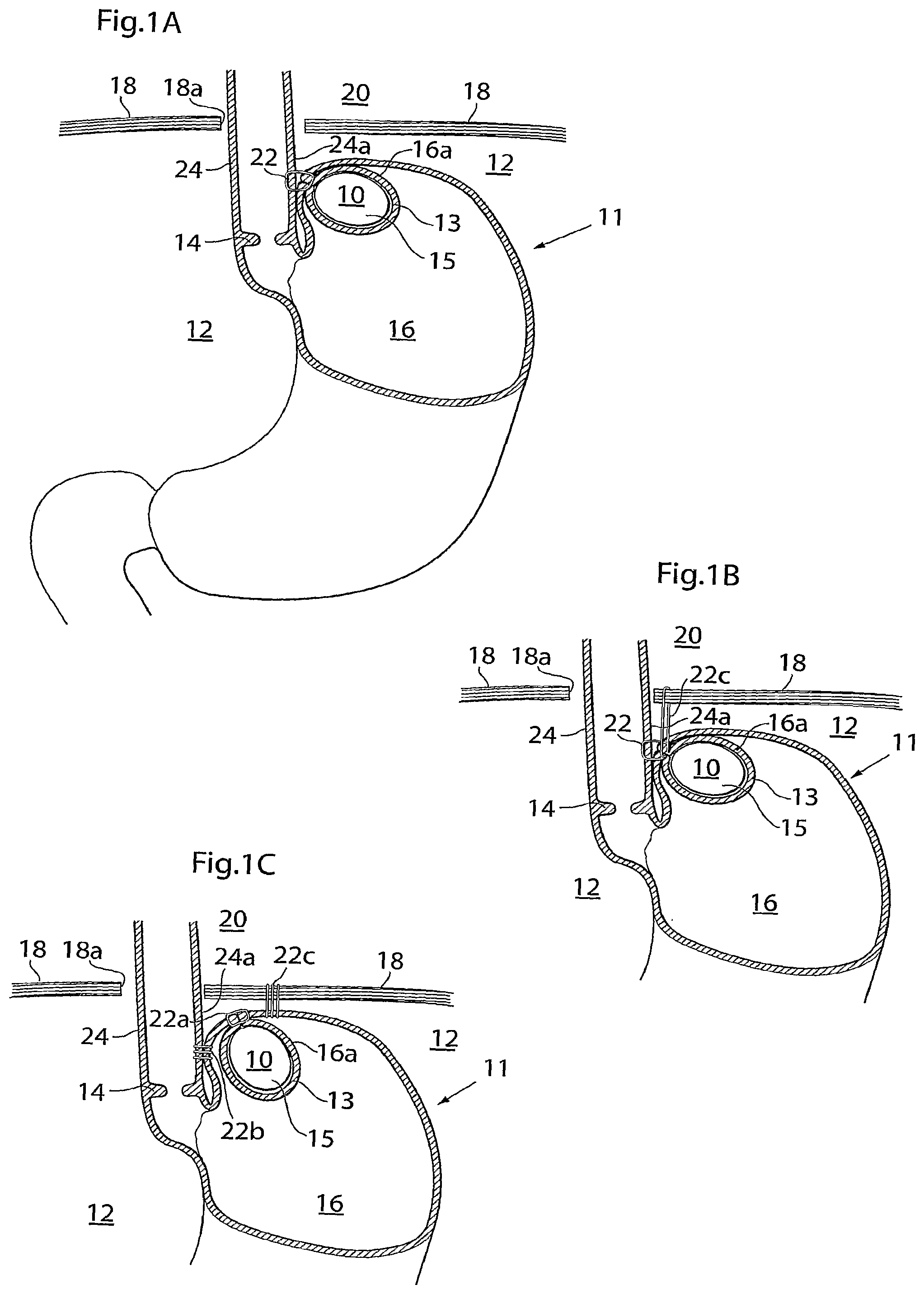 Patent US12090037 Figure 1 – Apparatus for treating obesity and reflux disease