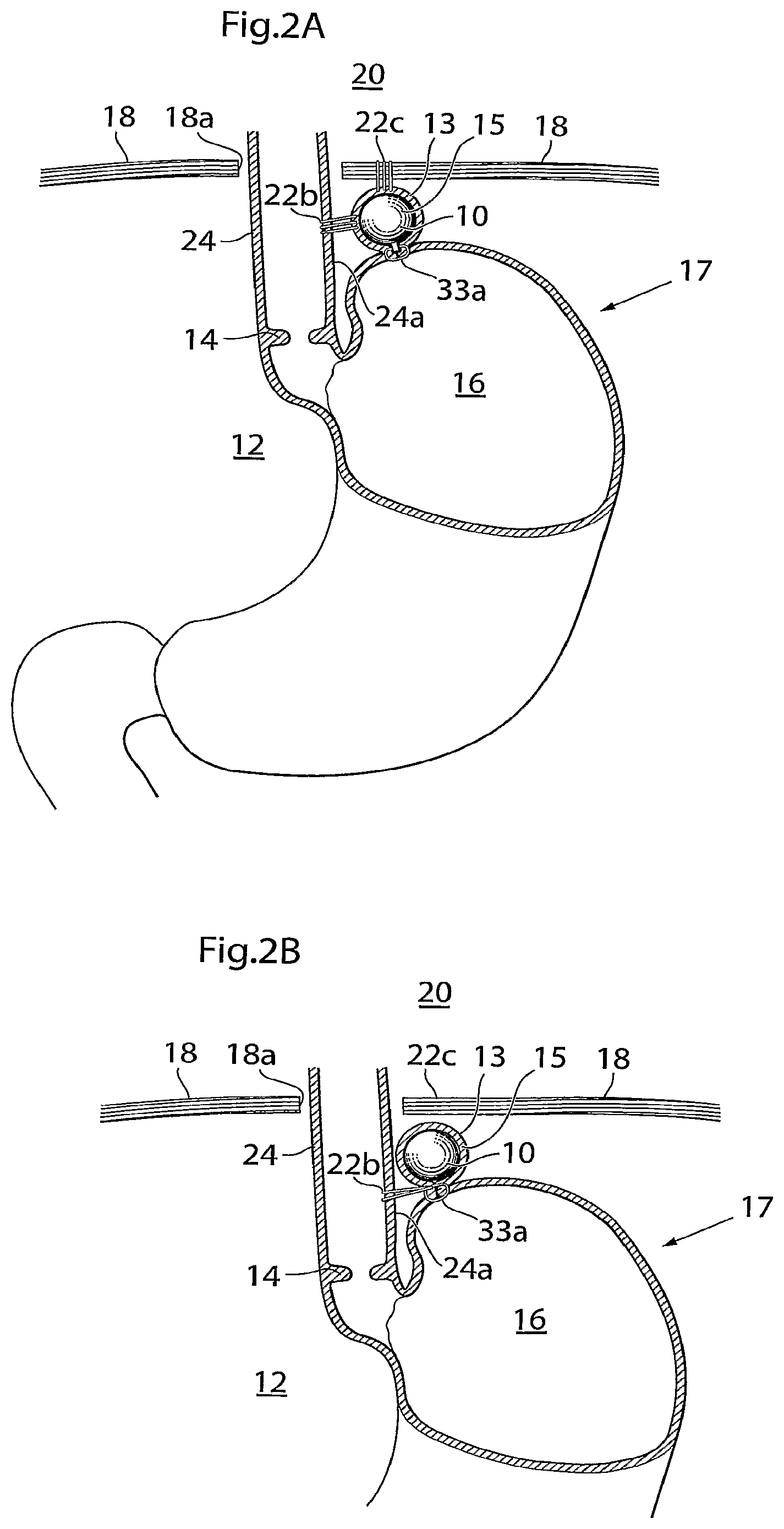 Patent US12090037 Figure 2 – Apparatus for treating obesity and reflux disease