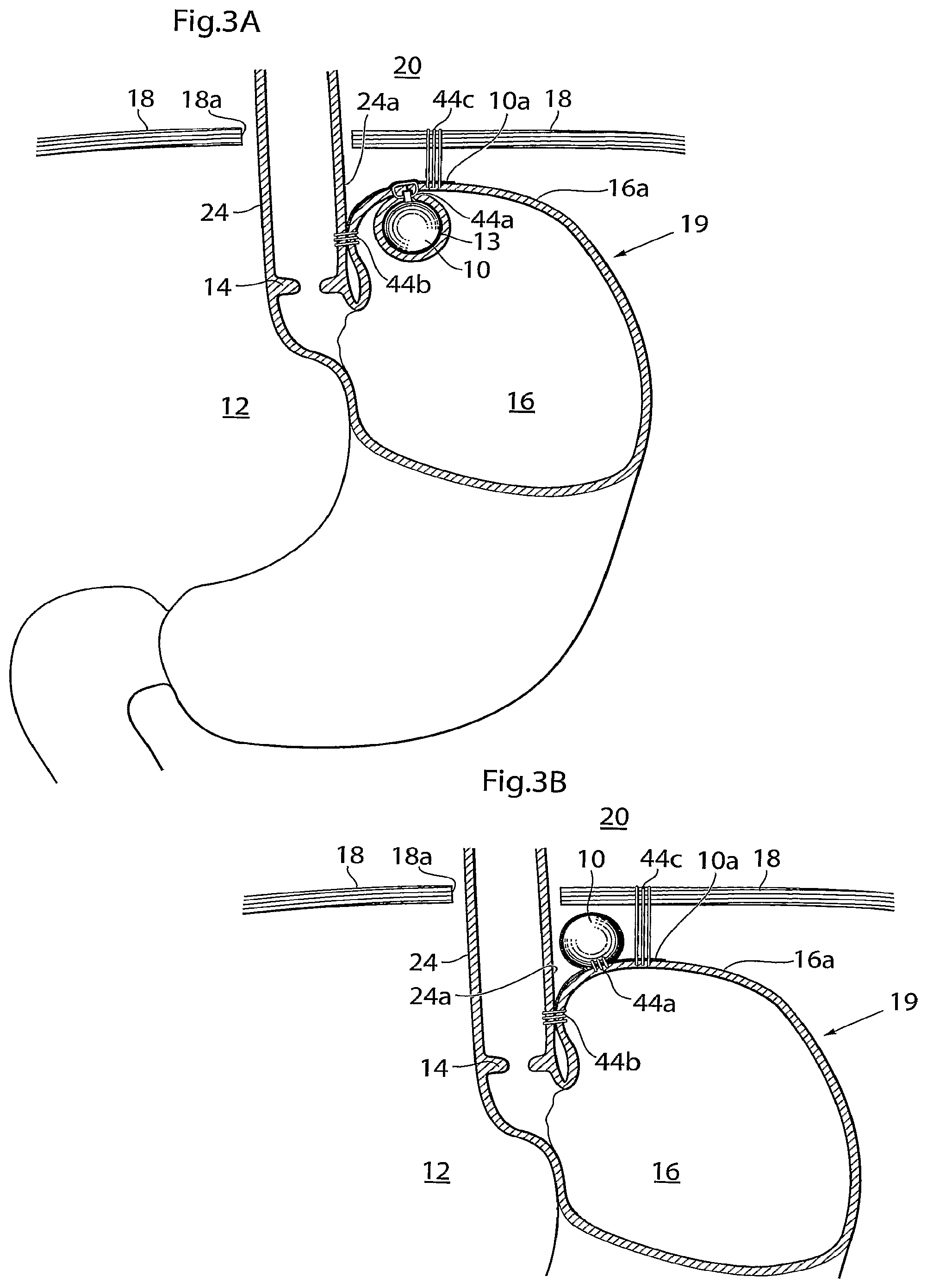 Patent US12090037 Figure 3 – Apparatus for treating obesity and reflux disease