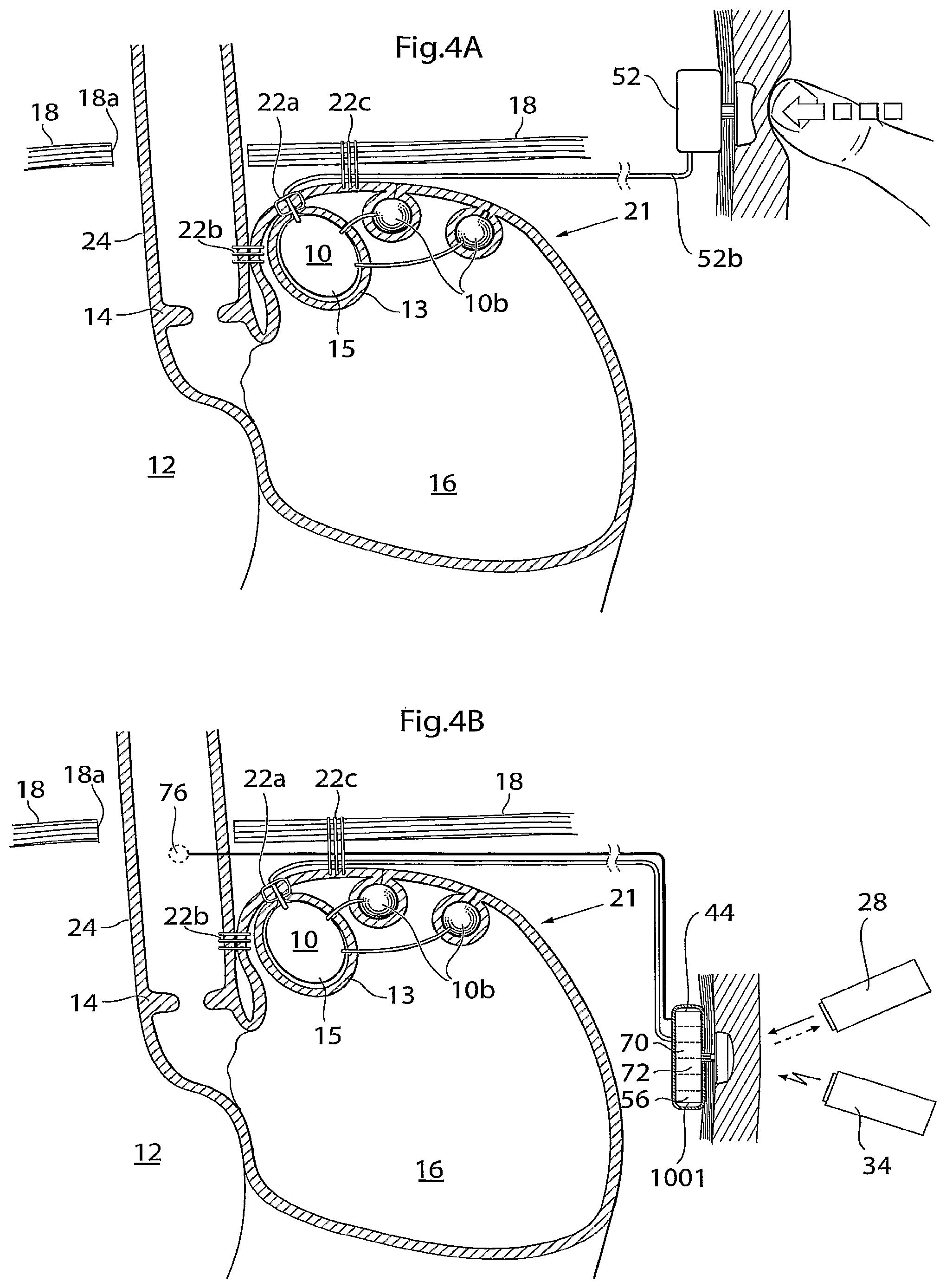 Patent US12090037 Figure 4 – Apparatus for treating obesity and reflux disease