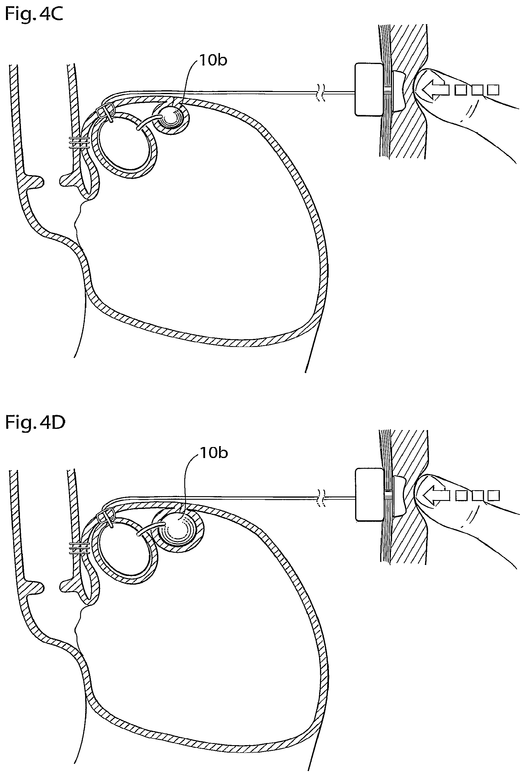 Patent US12090037 Figure 5 – Apparatus for treating obesity and reflux disease