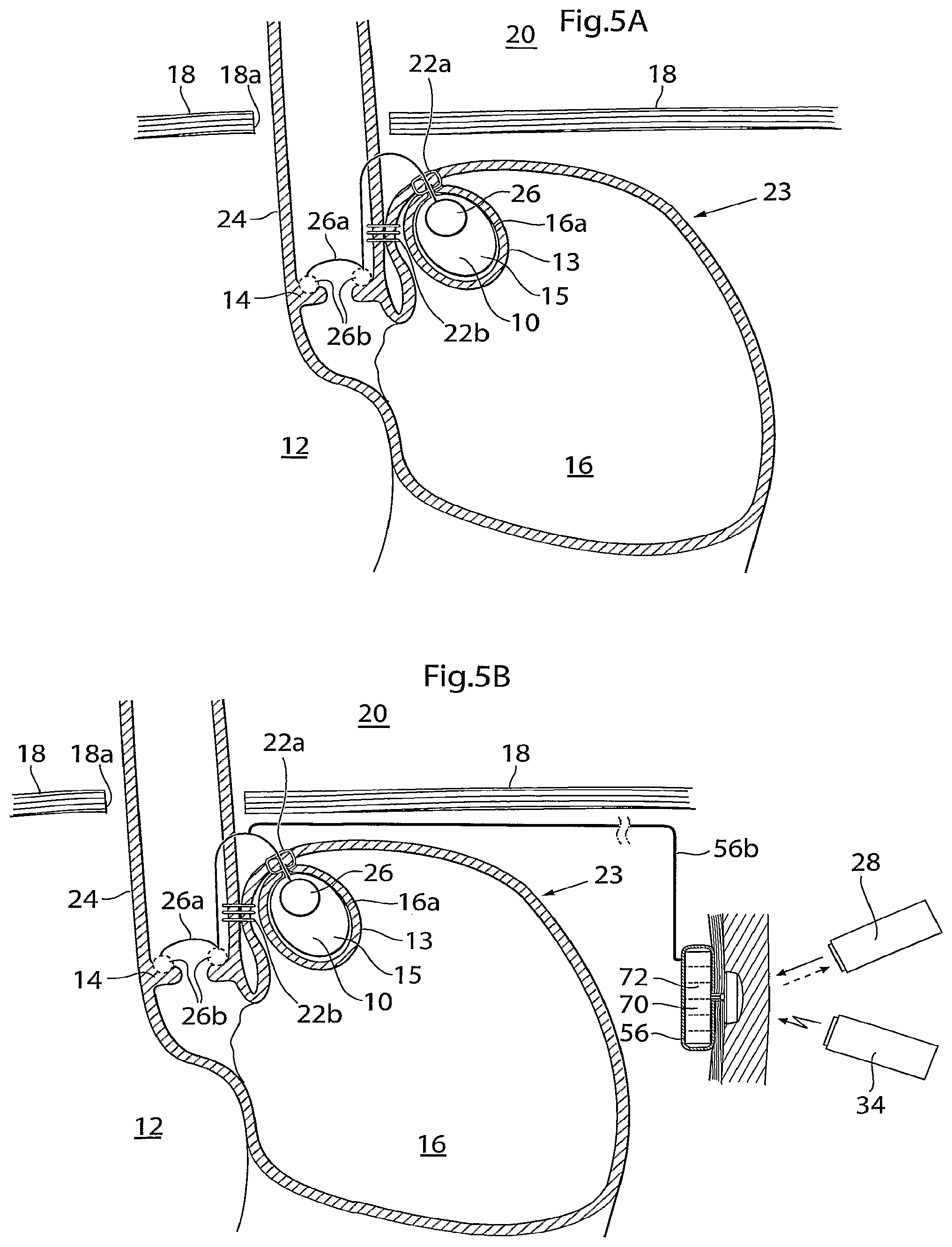 Patent US12090037 Figure 6 – Apparatus for treating obesity and reflux disease