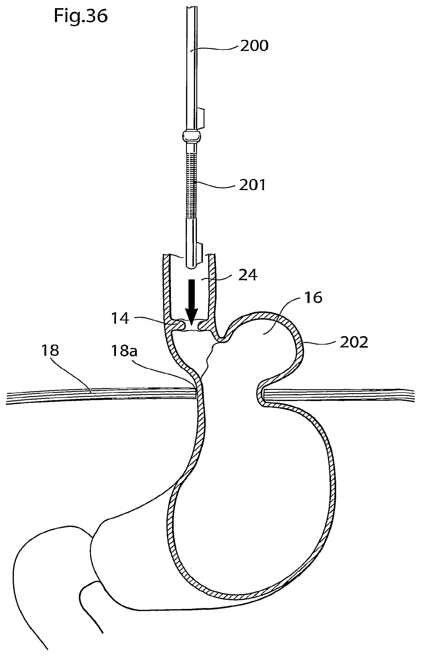 Patent US12090037 Figure 18 – Apparatus for treating obesity and reflux disease