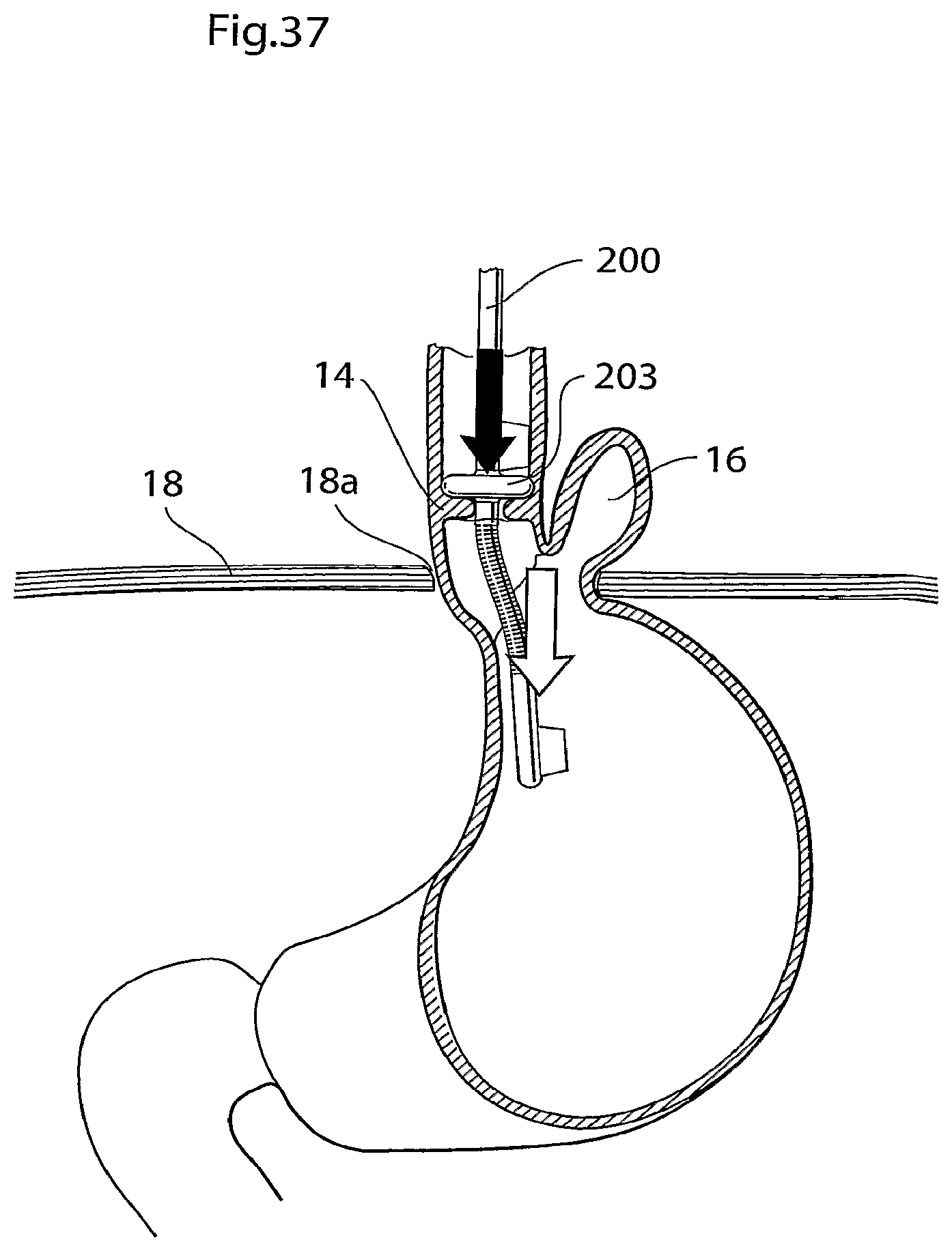 Patent US12090037 Figure 19 – Apparatus for treating obesity and reflux disease