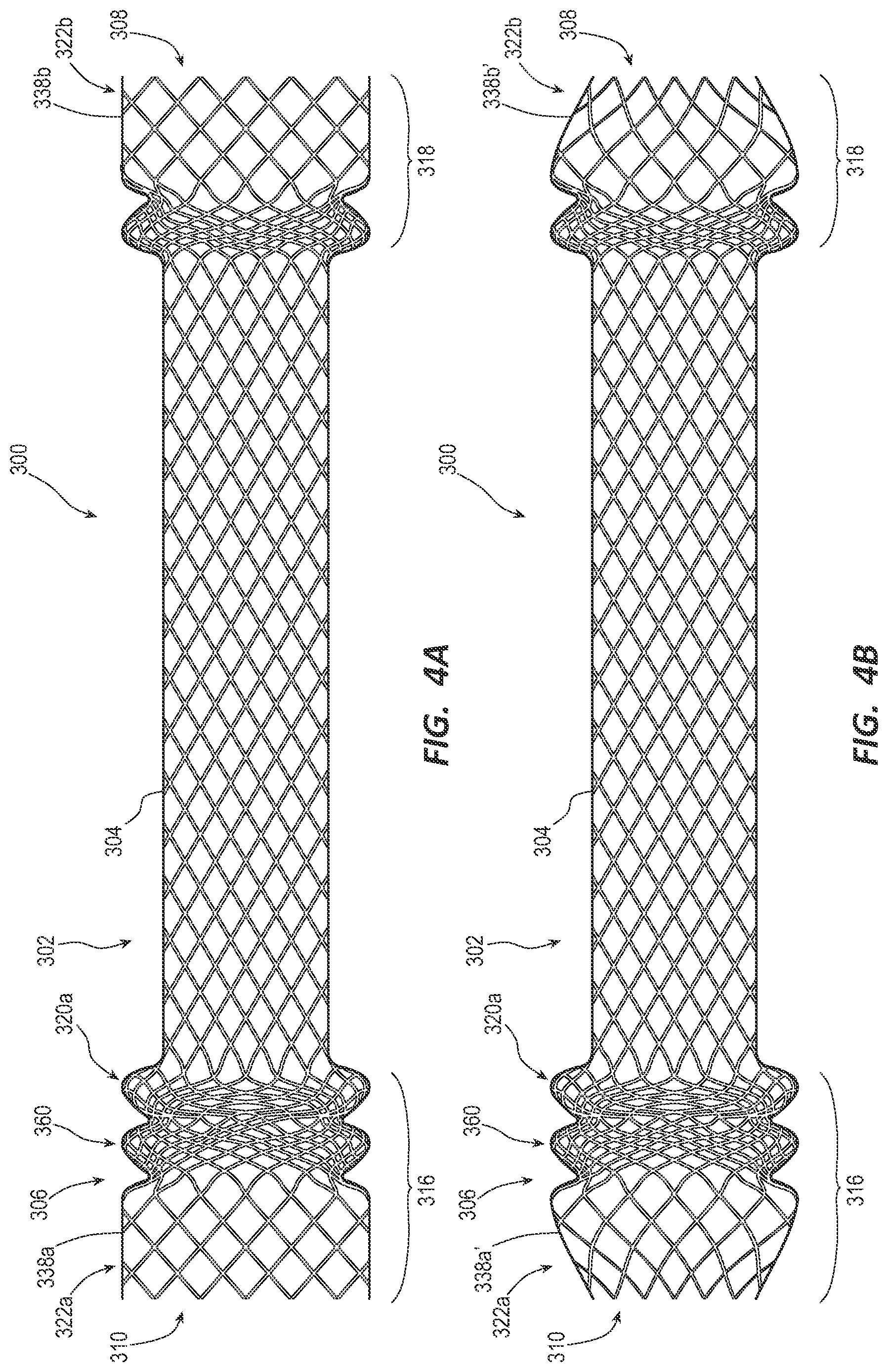 Patent US12090038 Figure 4 – Esophageal stents and related methods