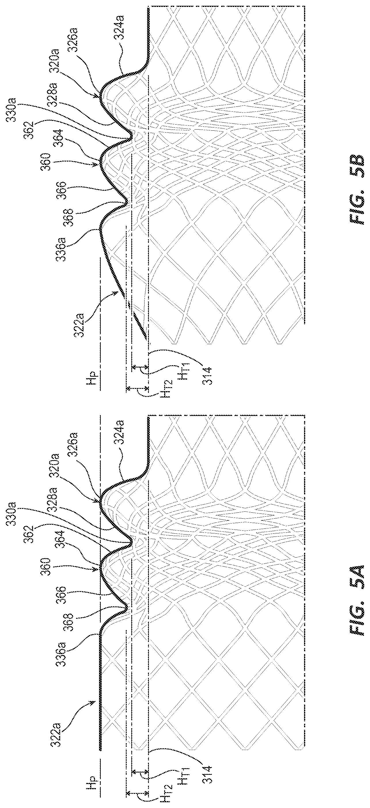 Patent US12090038 Figure 5 – Esophageal stents and related methods