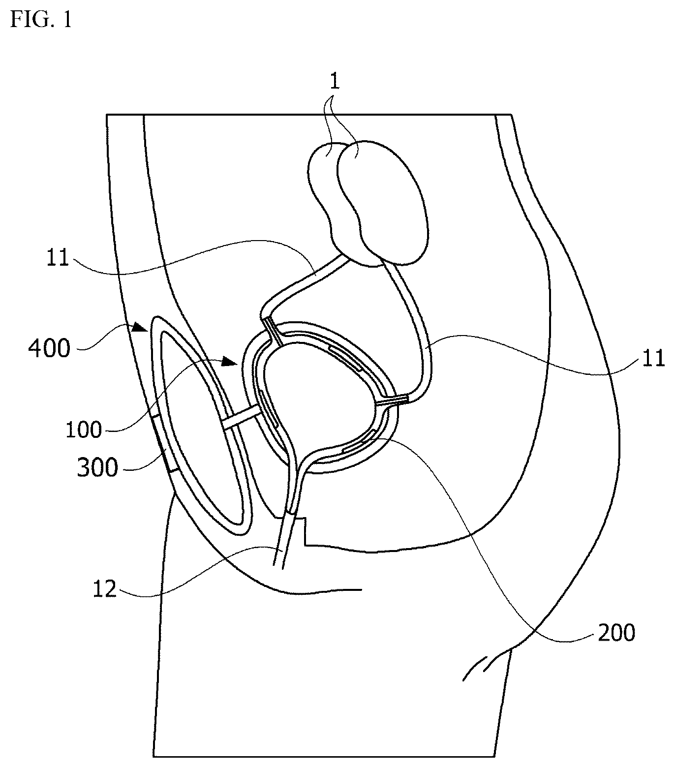 Patent US12090039 Figure 1 – Biomimetic artificial bladder and method for controlling same