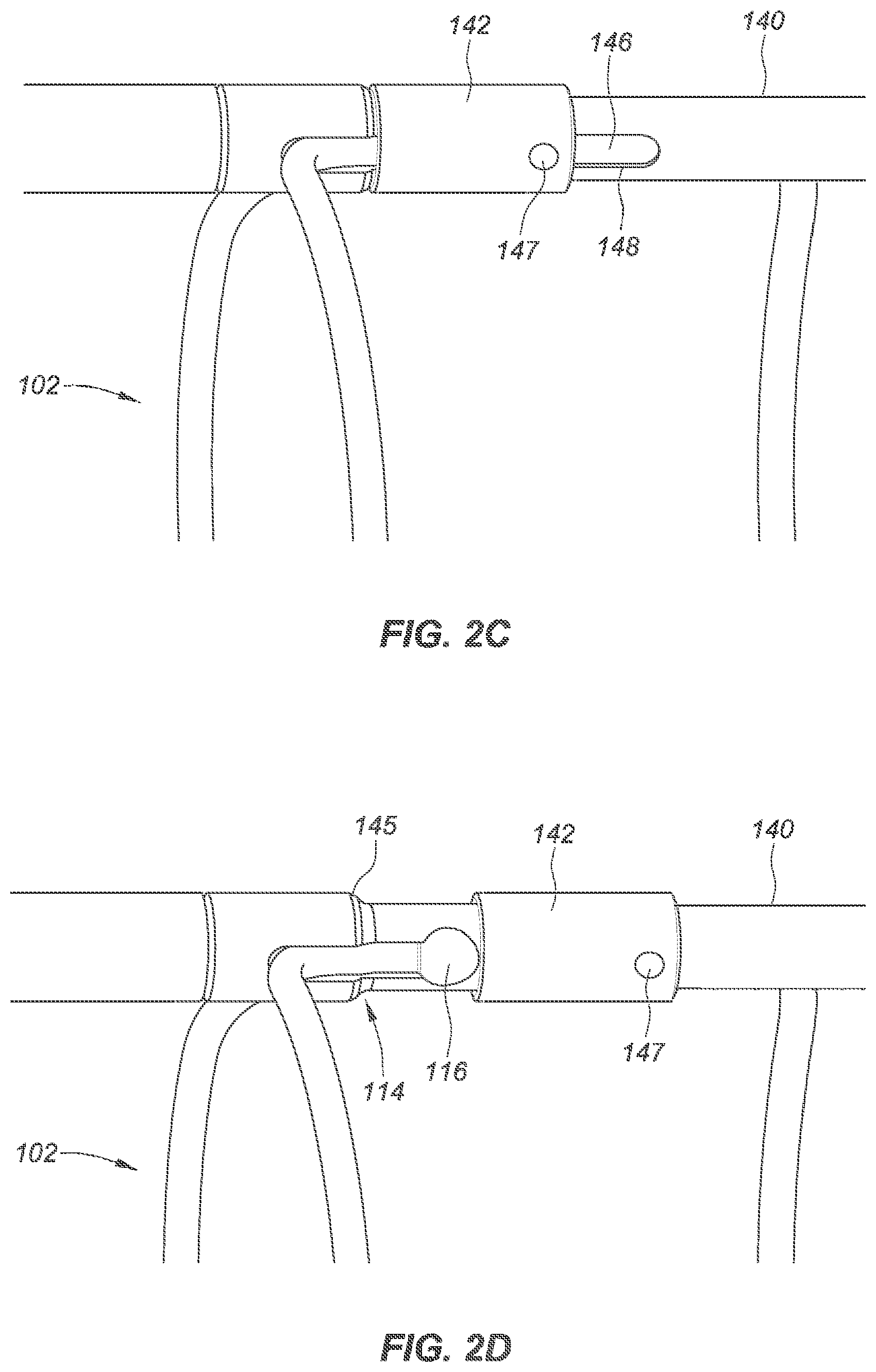 Patent US12090040 Figure 4 – Methods for deployment of an implant