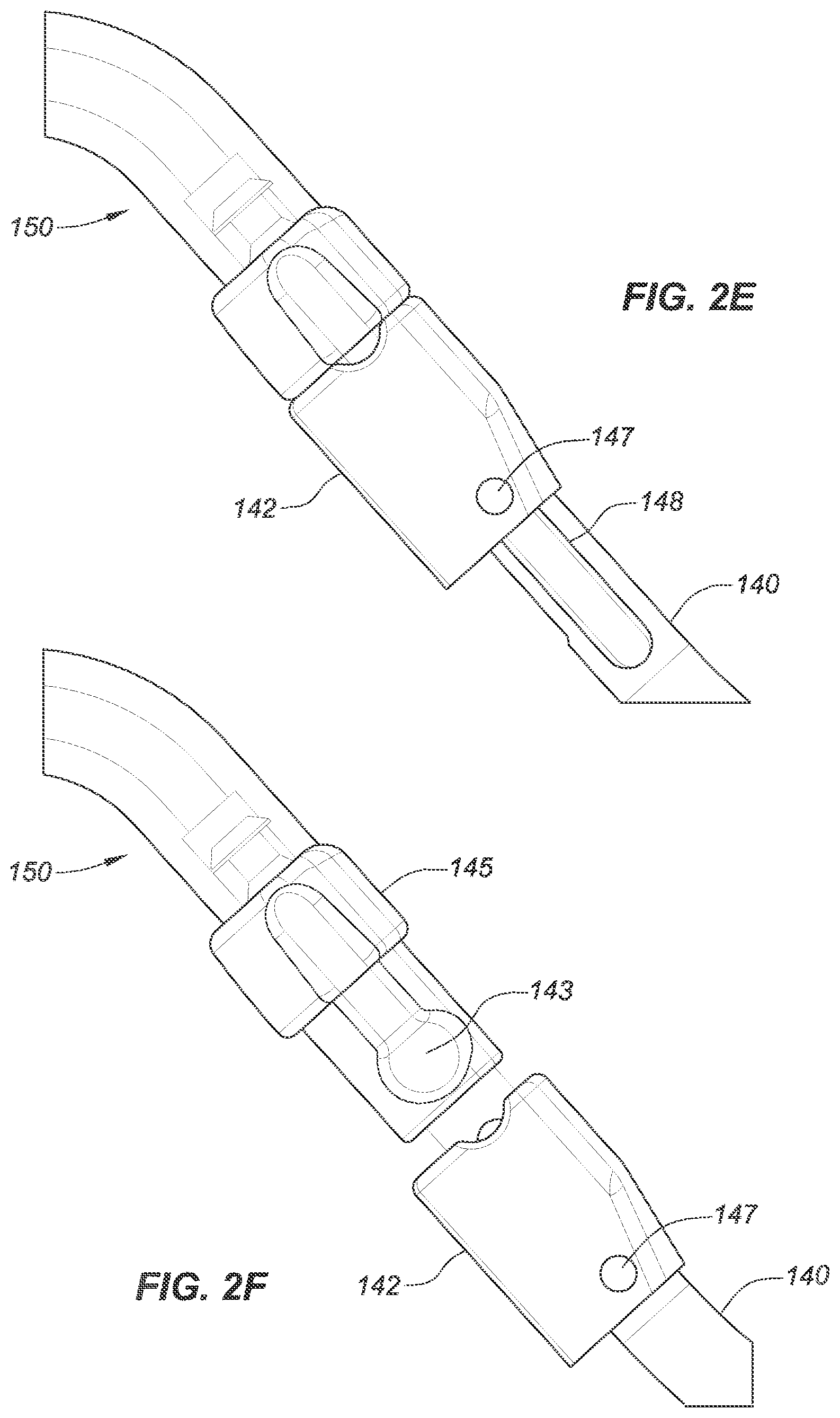 Patent US12090040 Figure 5 – Methods for deployment of an implant