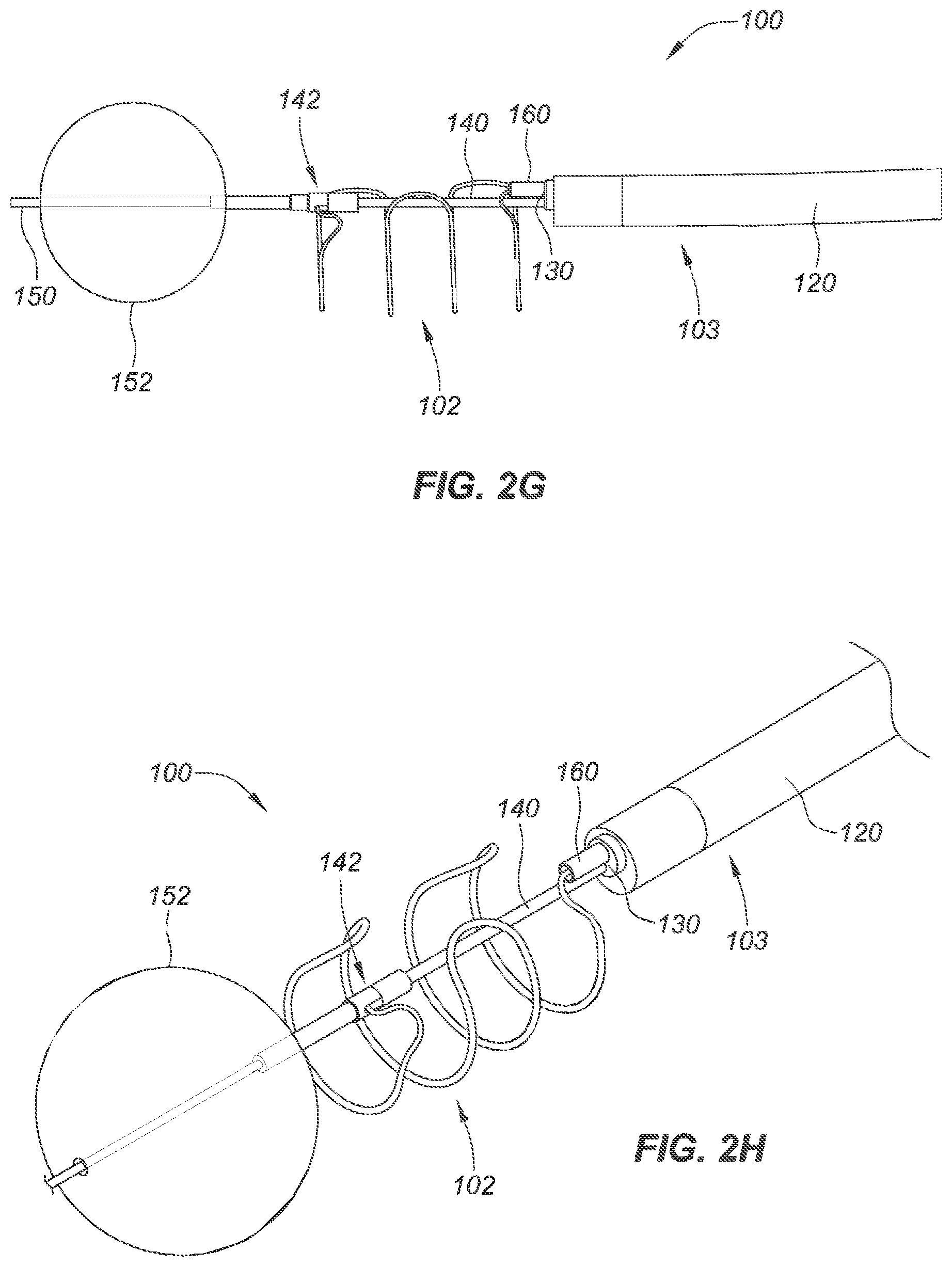 Patent US12090040 Figure 6 – Methods for deployment of an implant
