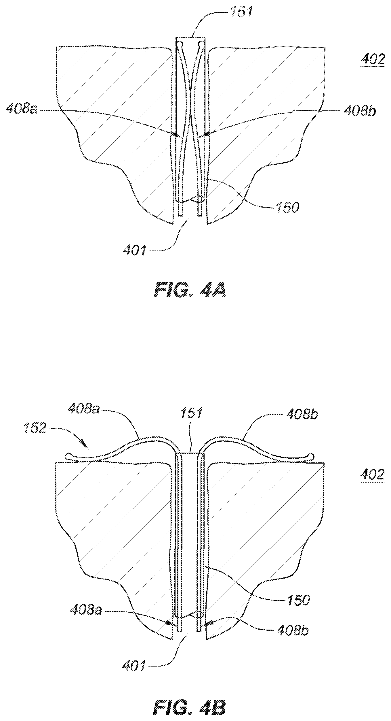 Patent US12090040 Figure 9 – Methods for deployment of an implant