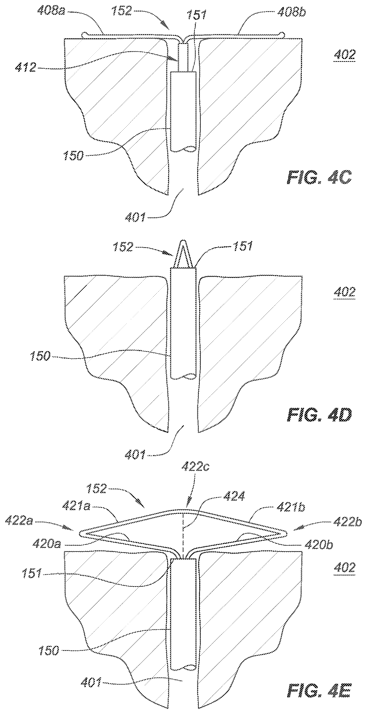Patent US12090040 Figure 10 – Methods for deployment of an implant