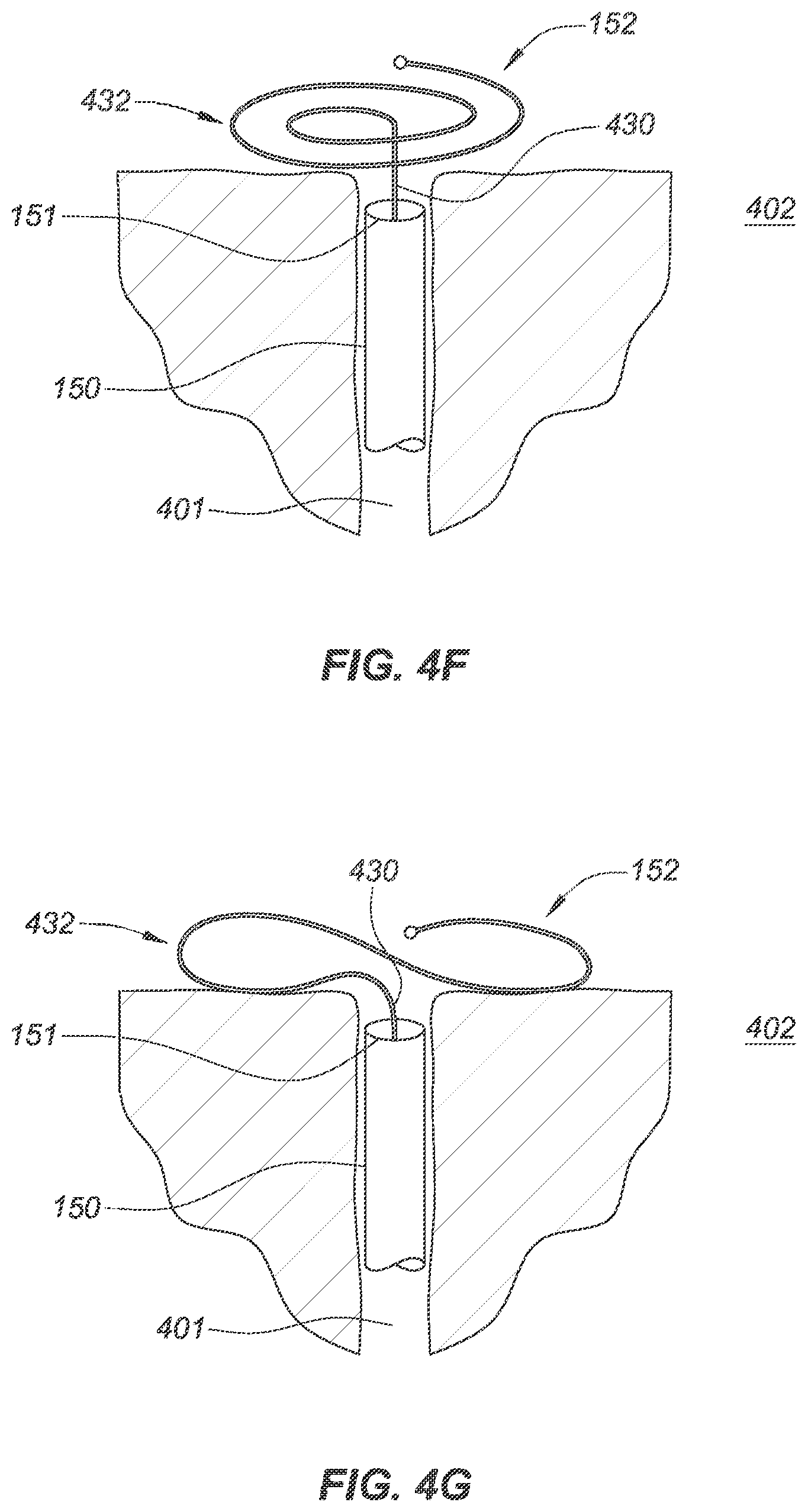 Patent US12090040 Figure 11 – Methods for deployment of an implant