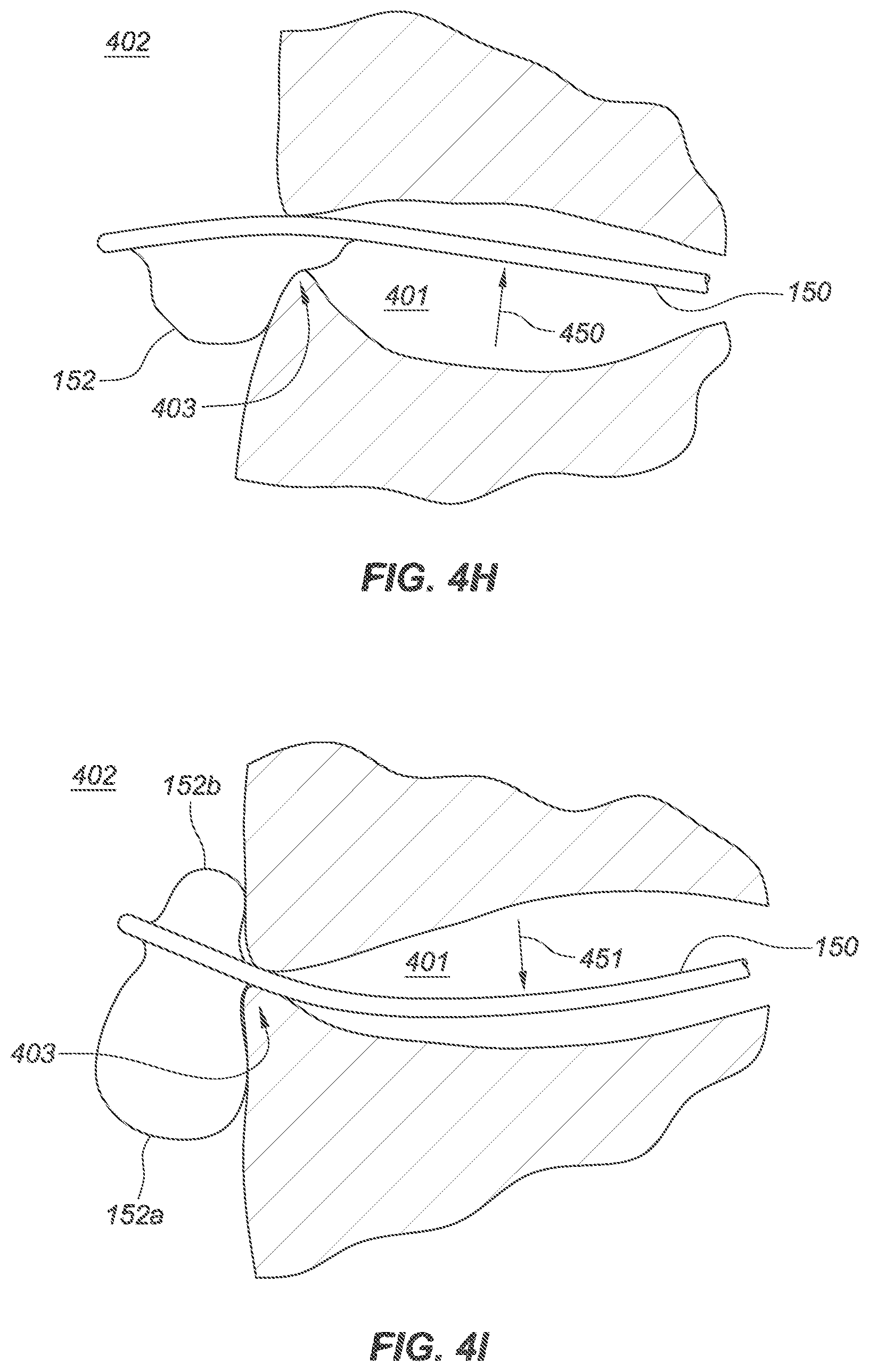 Patent US12090040 Figure 12 – Methods for deployment of an implant