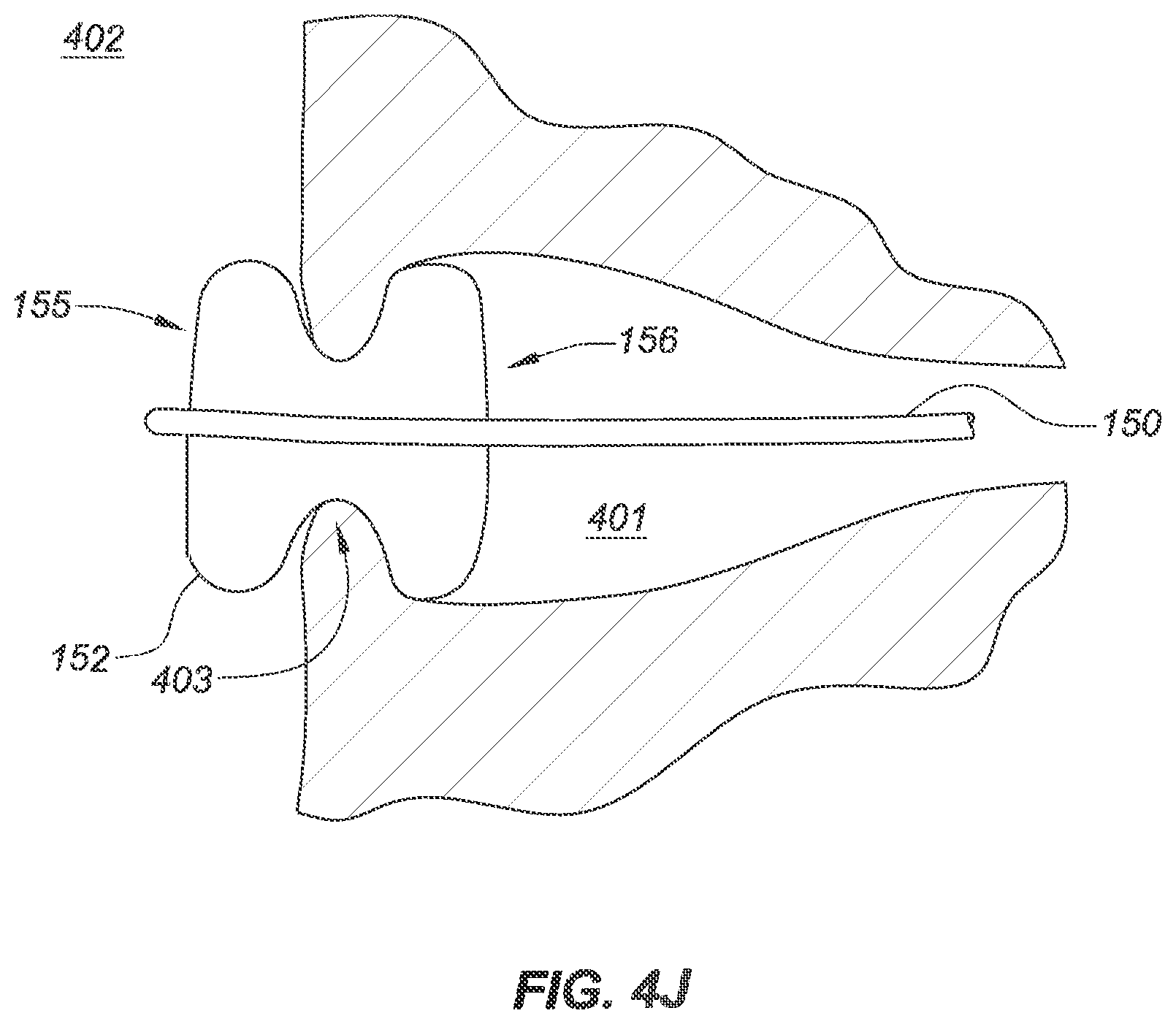 Patent US12090040 Figure 13 – Methods for deployment of an implant