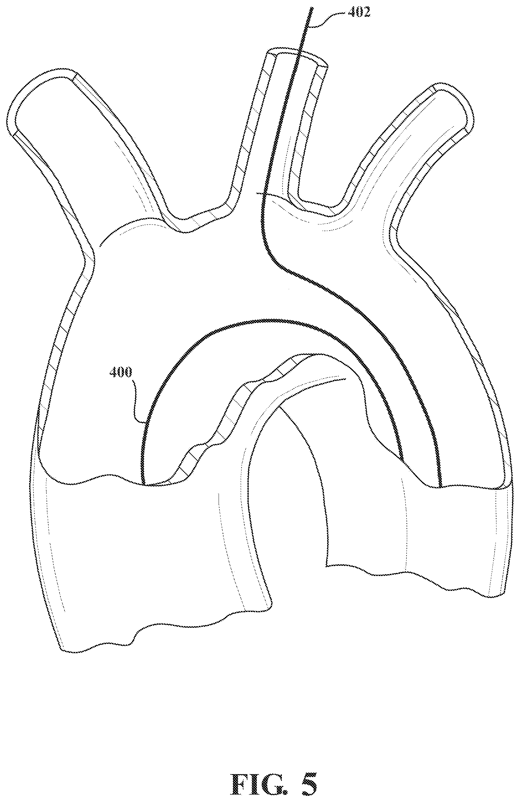 Patent US12090041 Figure 3 – Branched stent graft device and deployment