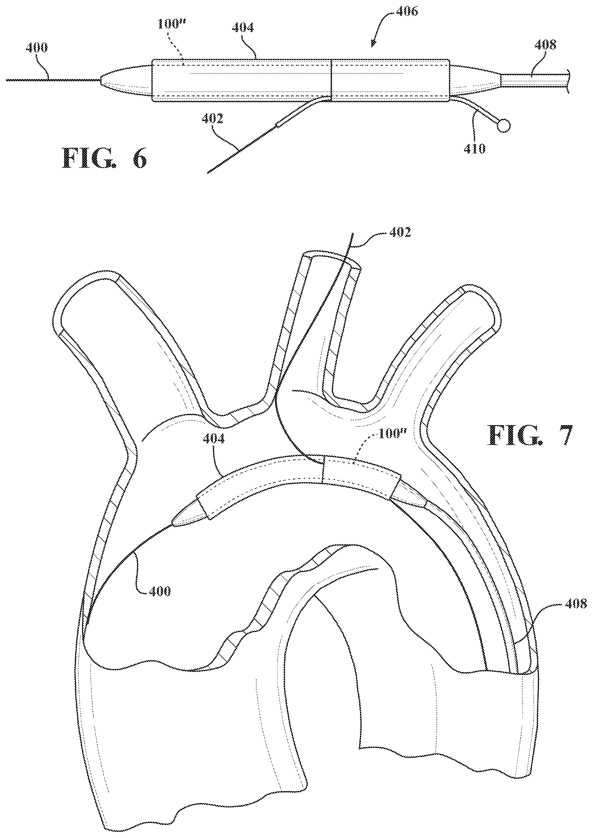 Patent US12090041 Figure 4 – Branched stent graft device and deployment