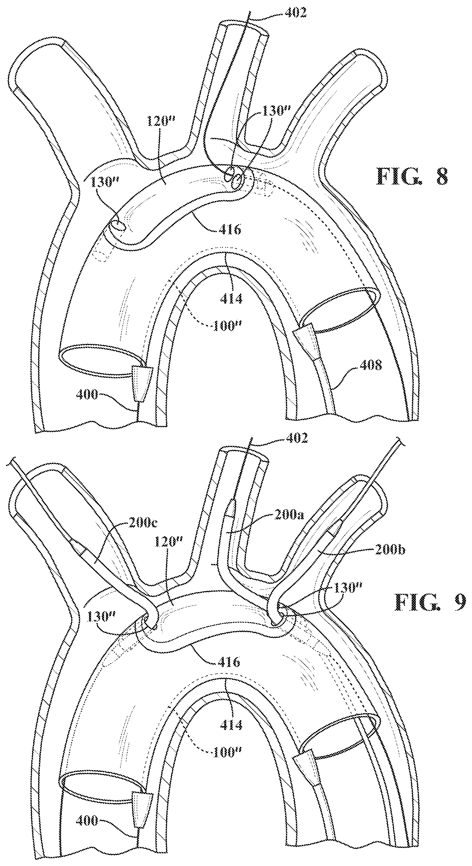 Patent US12090041 Figure 5 – Branched stent graft device and deployment