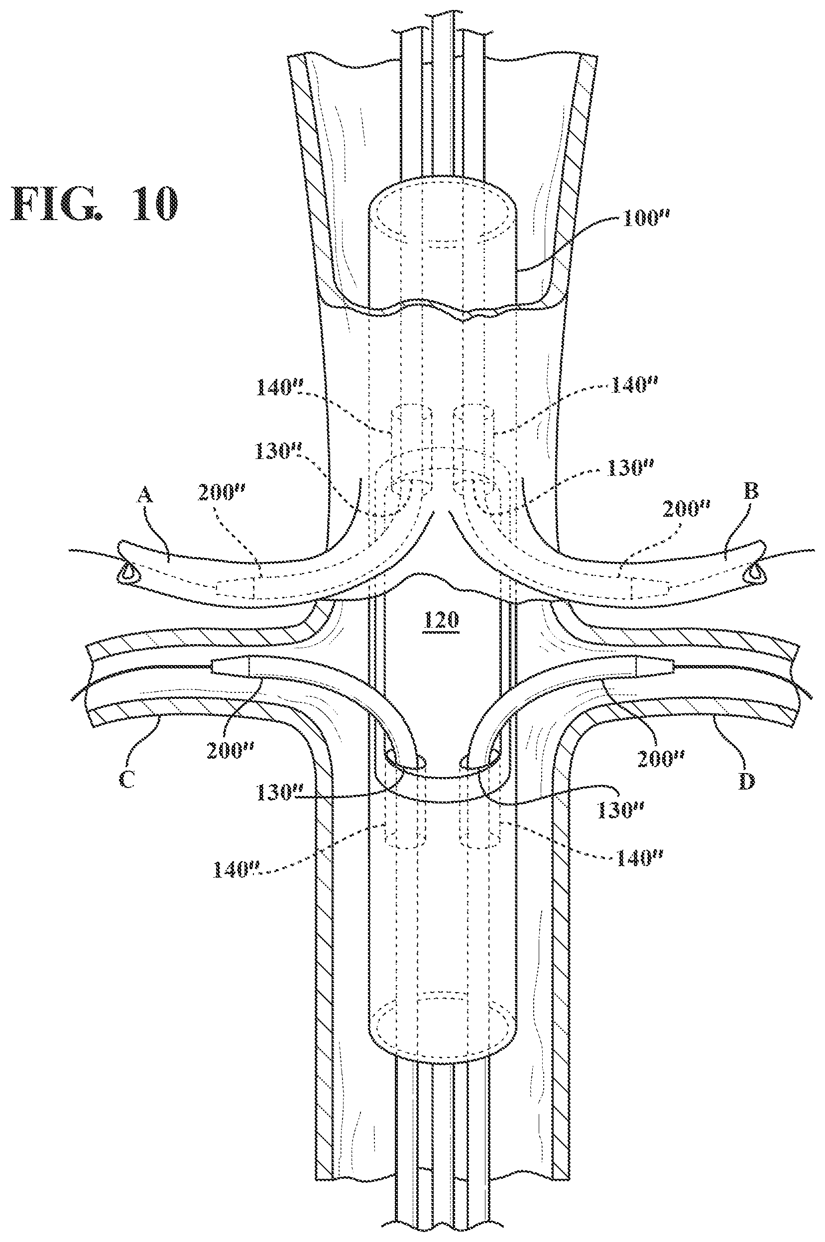 Patent US12090041 Figure 6 – Branched stent graft device and deployment