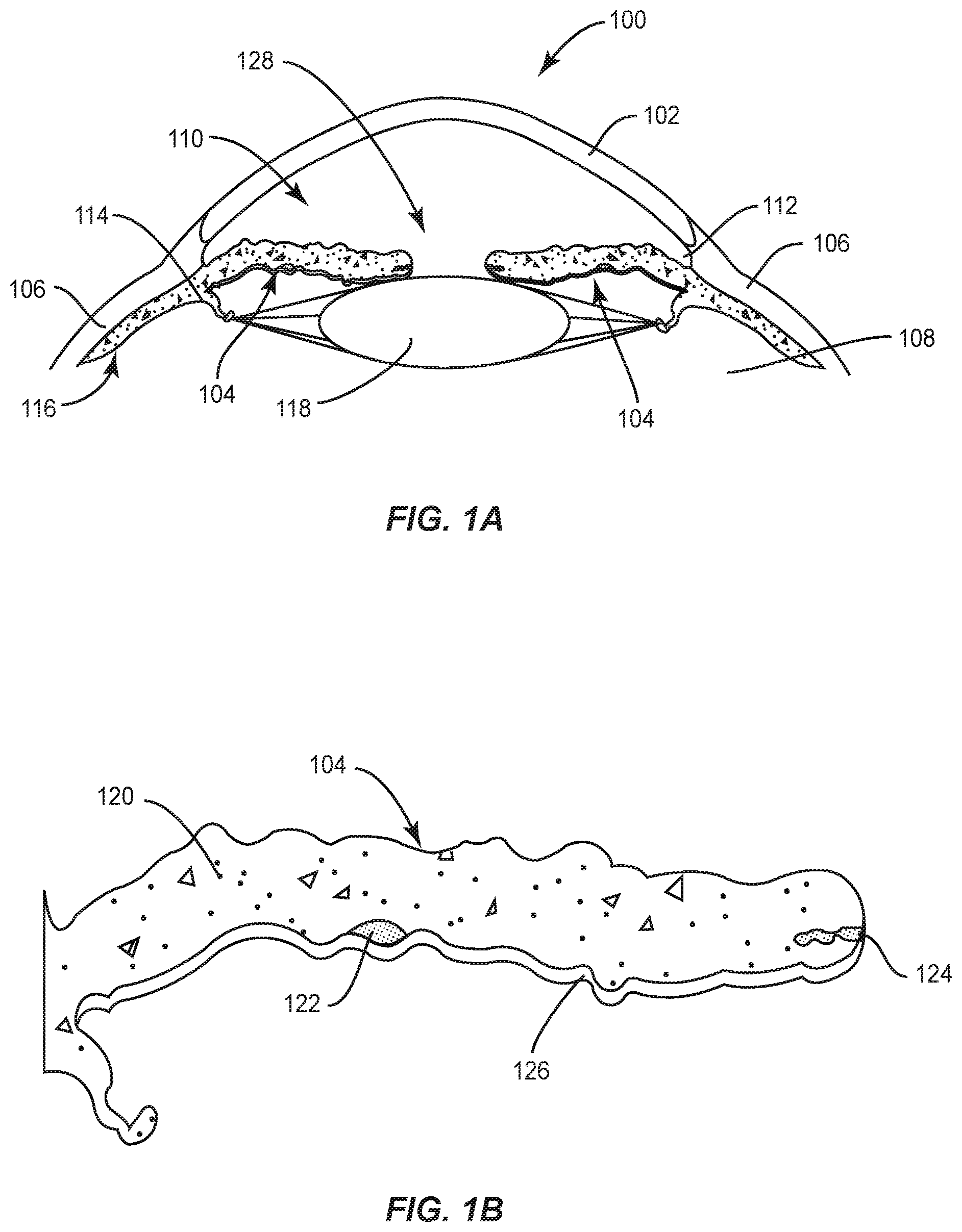 Patent US12090042 Figure 1 – Intraocular lenses (IOLs) and related assemblies and intraocular attachment methods