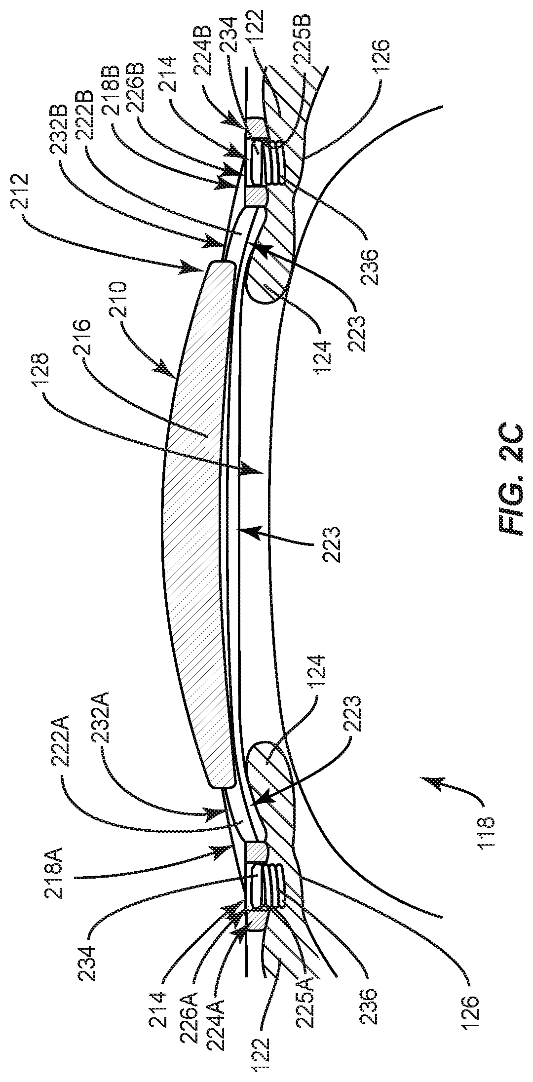 Patent US12090042 Figure 3 – Intraocular lenses (IOLs) and related assemblies and intraocular attachment methods