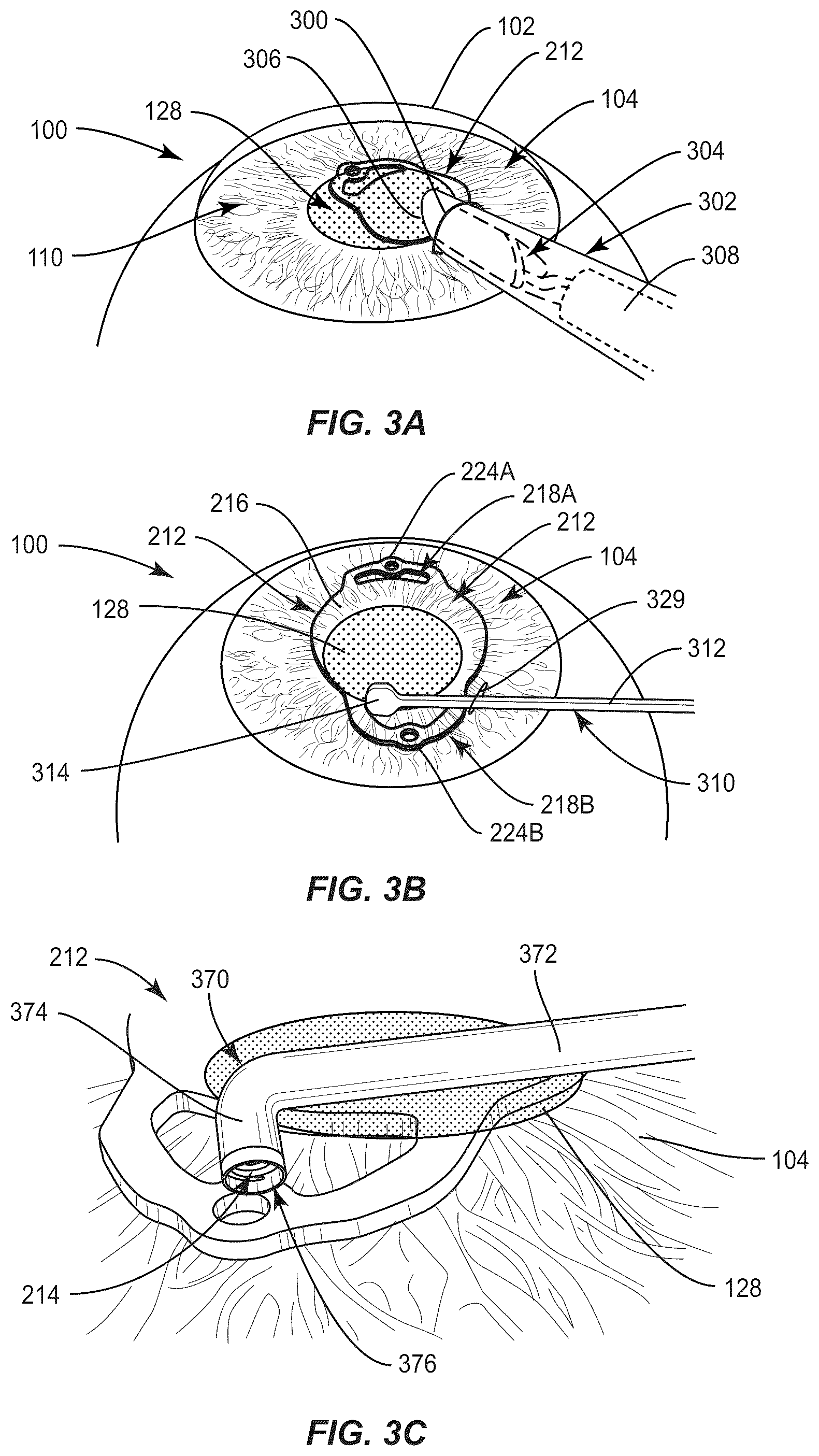 Patent US12090042 Figure 6 – Intraocular lenses (IOLs) and related assemblies and intraocular attachment methods