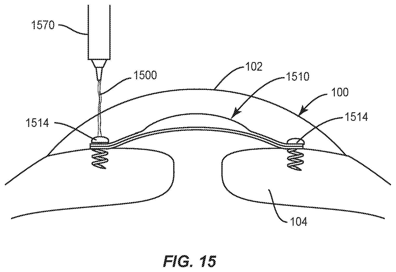 Patent US12090042 Figure 17 – Intraocular lenses (IOLs) and related assemblies and intraocular attachment methods