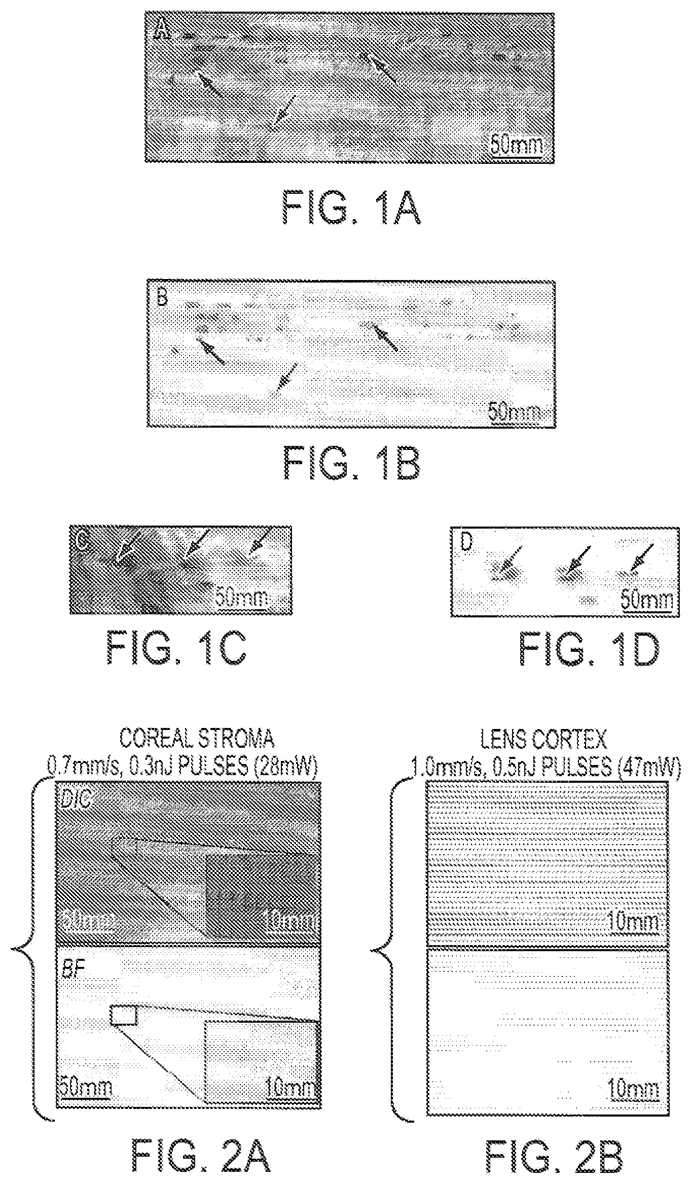 Patent US12090043 Figure 1 – Vision correction with laser refractive index changes