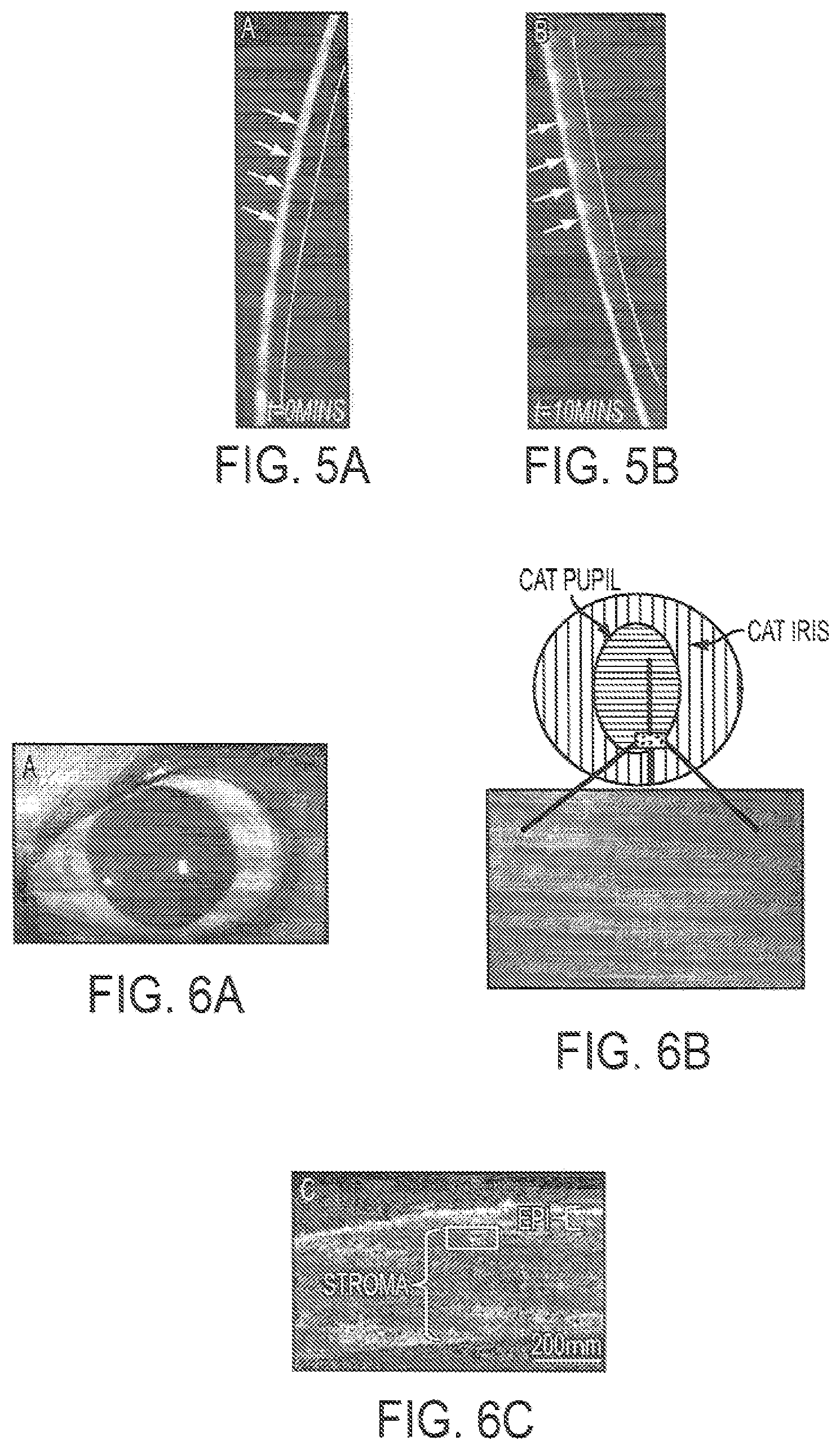 Patent US12090043 Figure 5 – Vision correction with laser refractive index changes