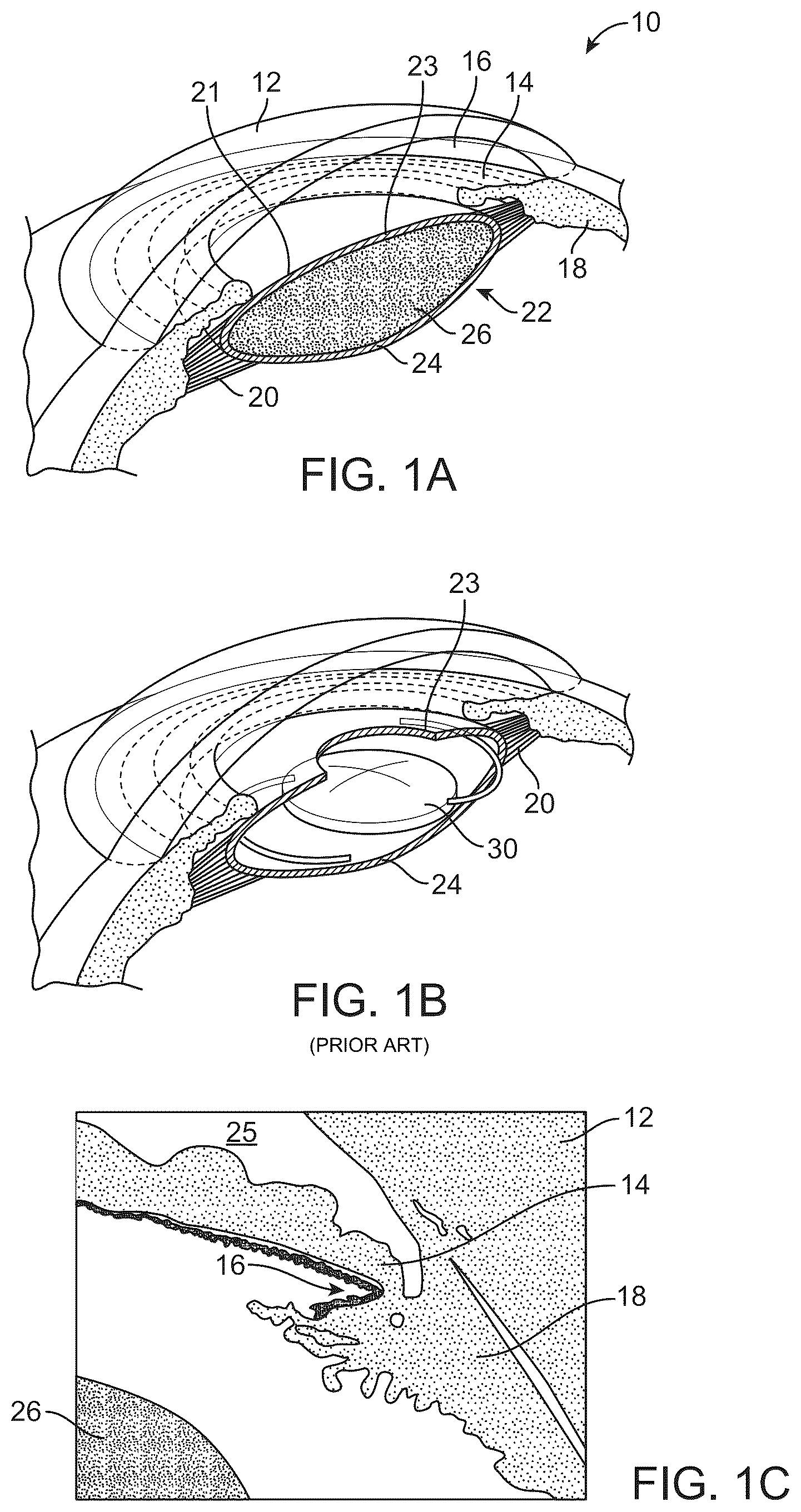 Patent US12090044 Figure 1 – Accommodating intraocular lens