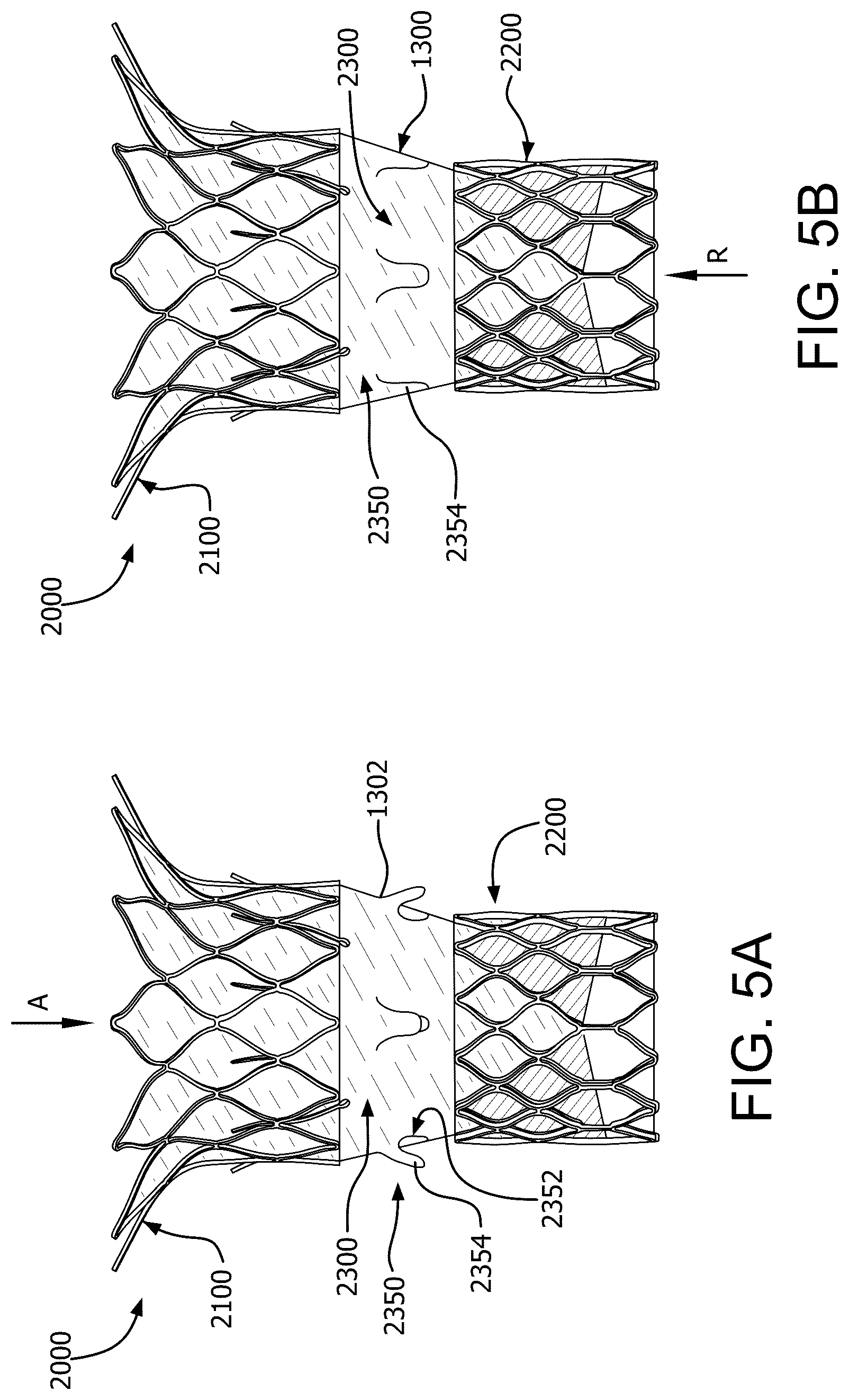 Patent US12090046 Figure 14 – Telescoping prosthetic valve with retention element