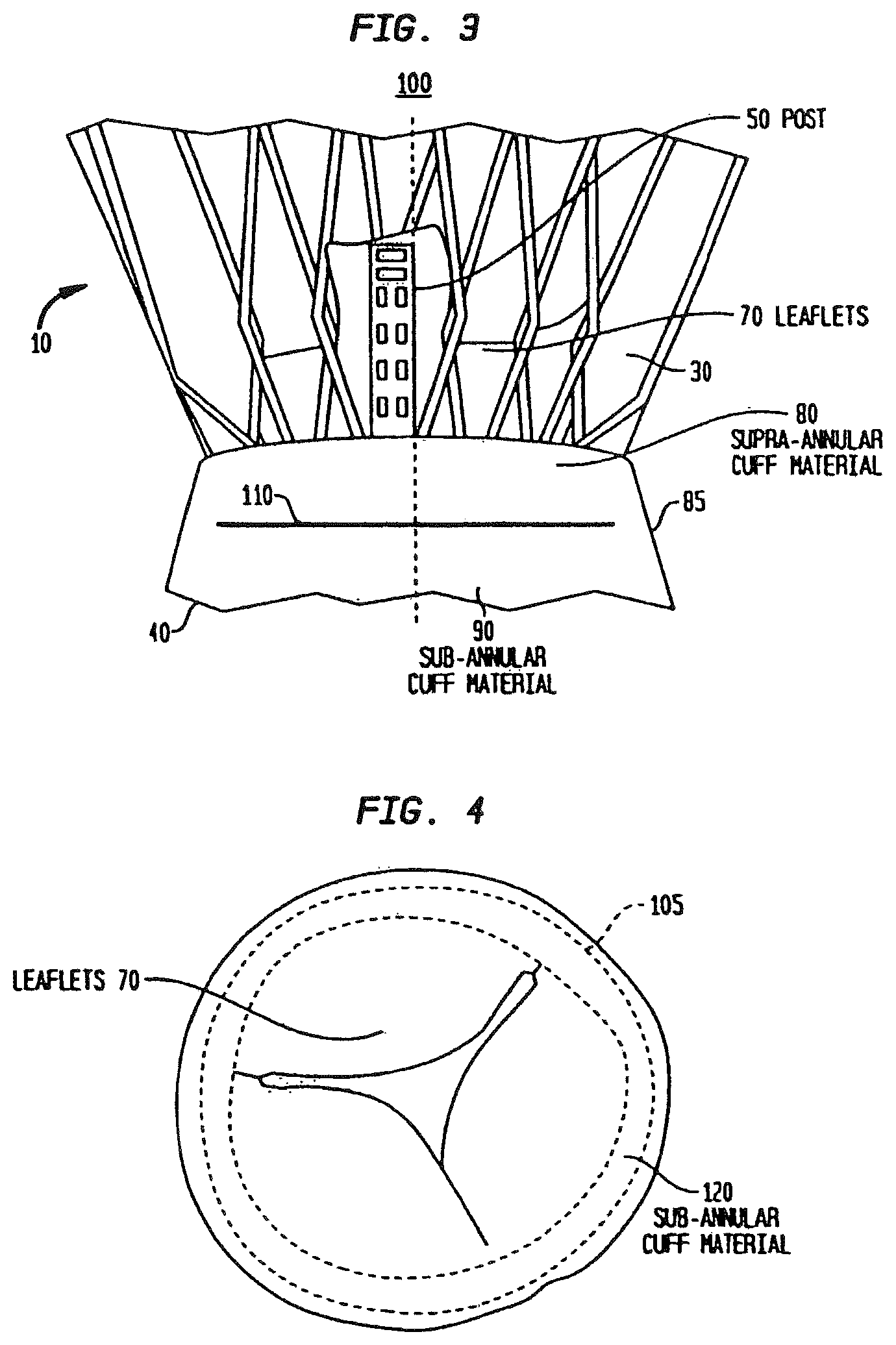 Patent US12090047 Figure 3 – Collapsible and re-expandable prosthetic heart valve cuff designs and complementary technological applications