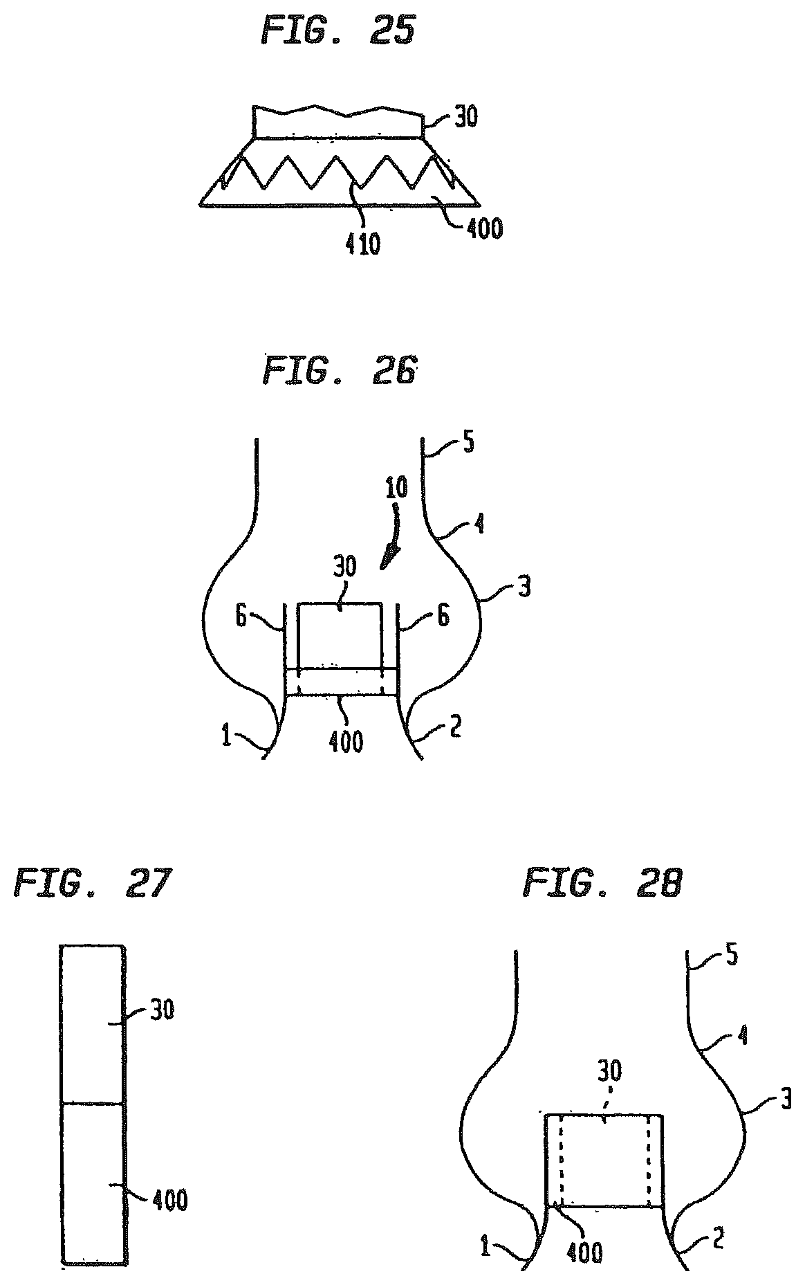 Patent US12090047 Figure 14 – Collapsible and re-expandable prosthetic heart valve cuff designs and complementary technological applications