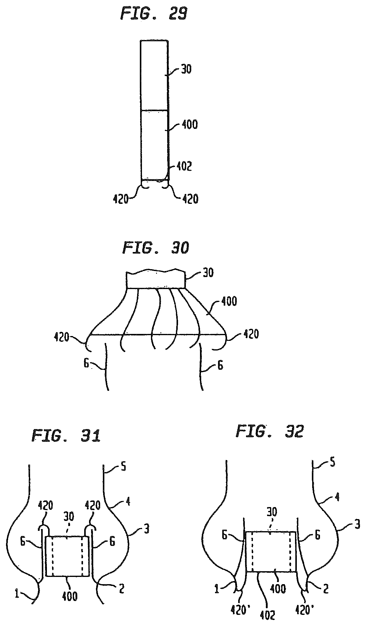 Patent US12090047 Figure 15 – Collapsible and re-expandable prosthetic heart valve cuff designs and complementary technological applications