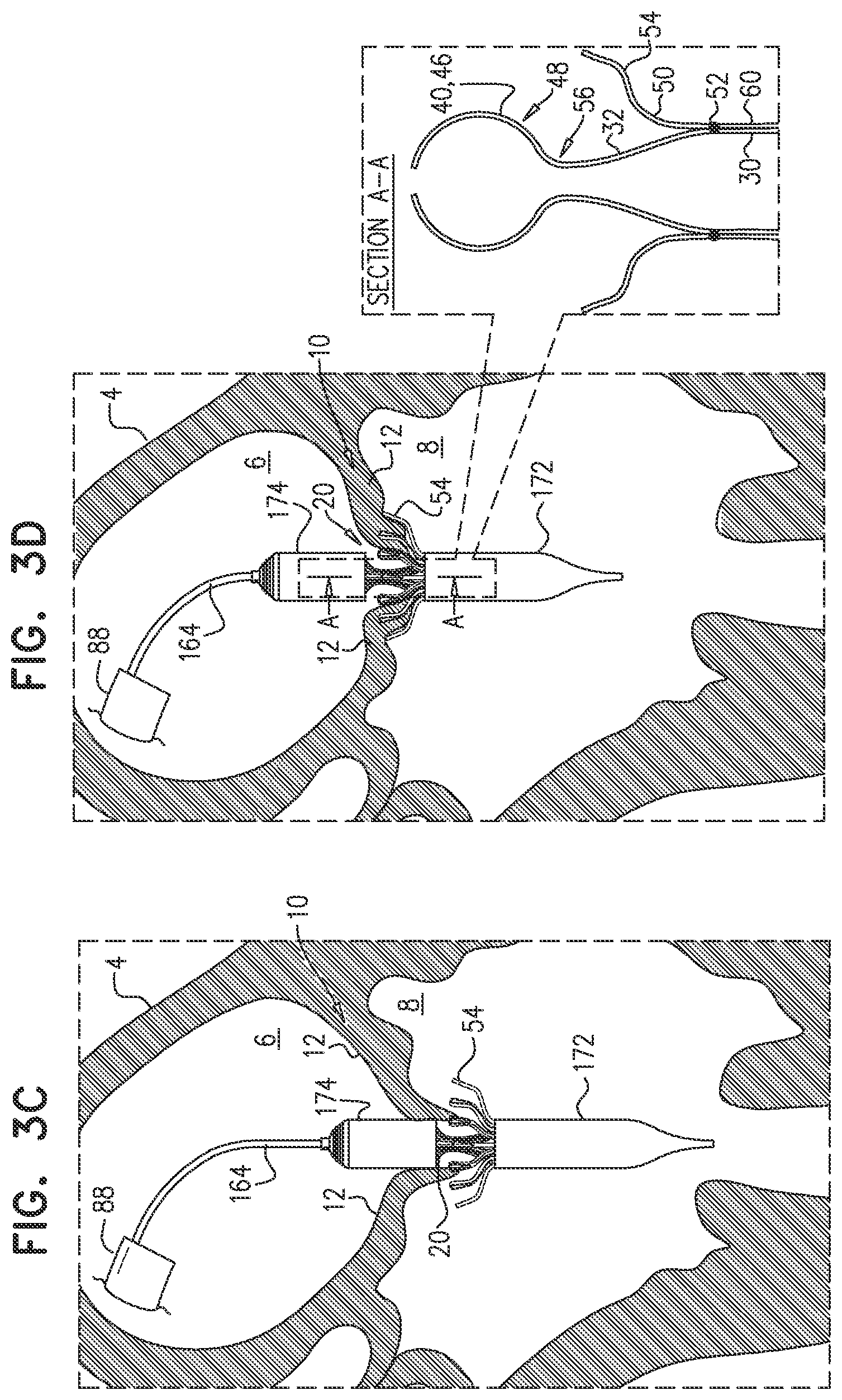 Patent US12090048 Figure 6 – Prosthetic heart valve
