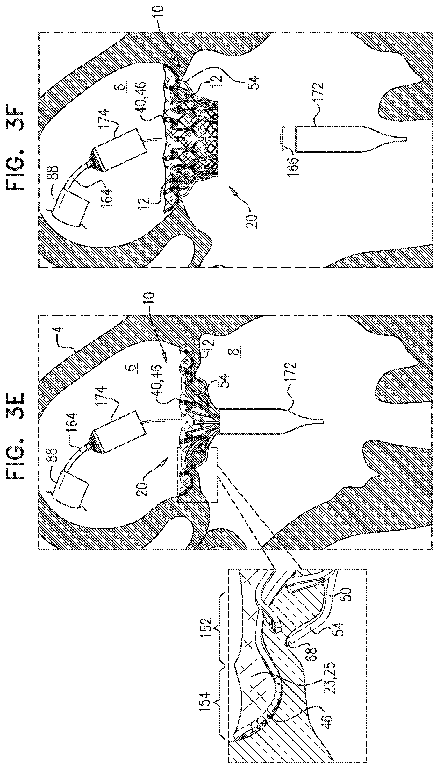 Patent US12090048 Figure 7 – Prosthetic heart valve