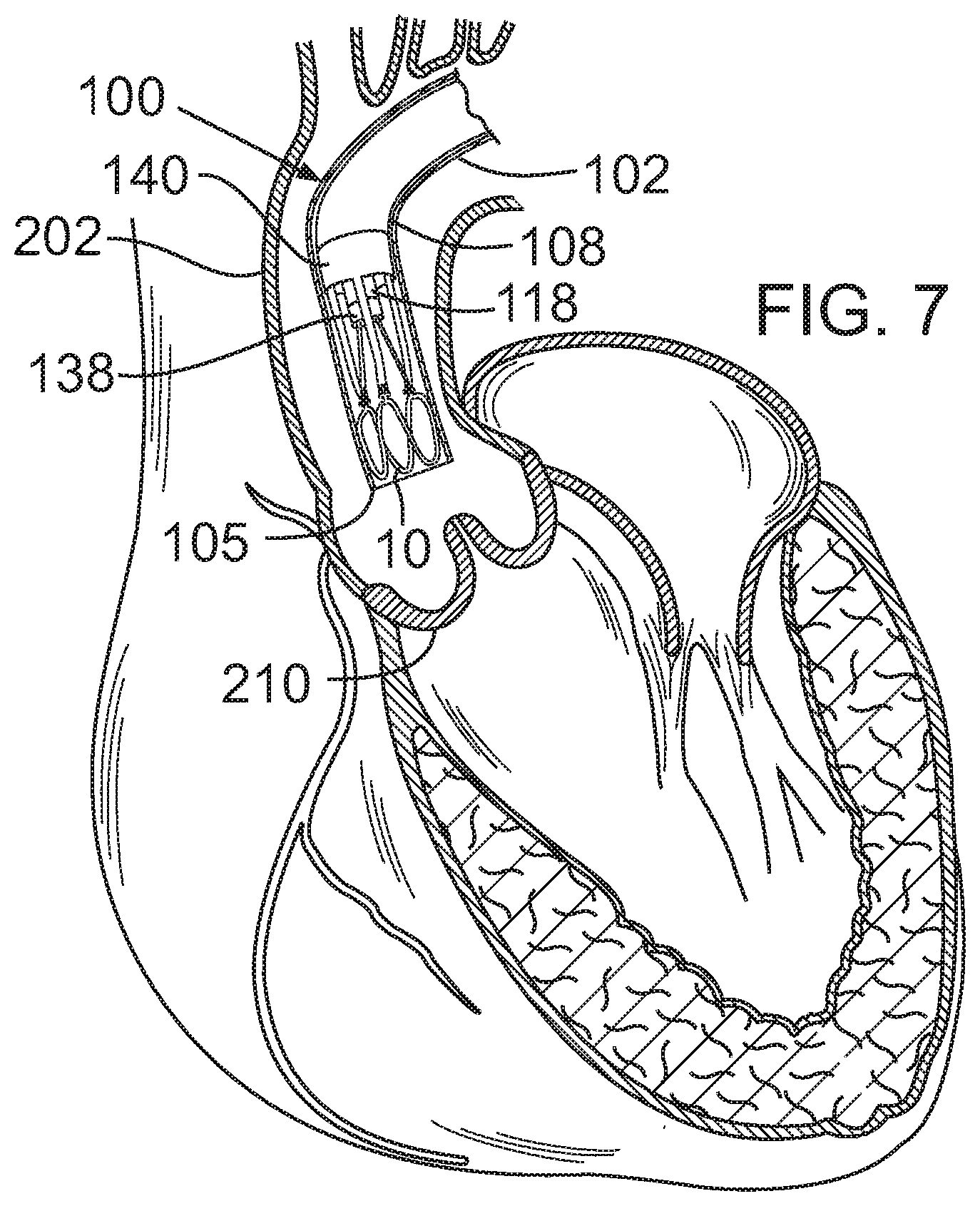 Patent US12090049 Figure 3 – Retaining mechanisms for prosthetic valves