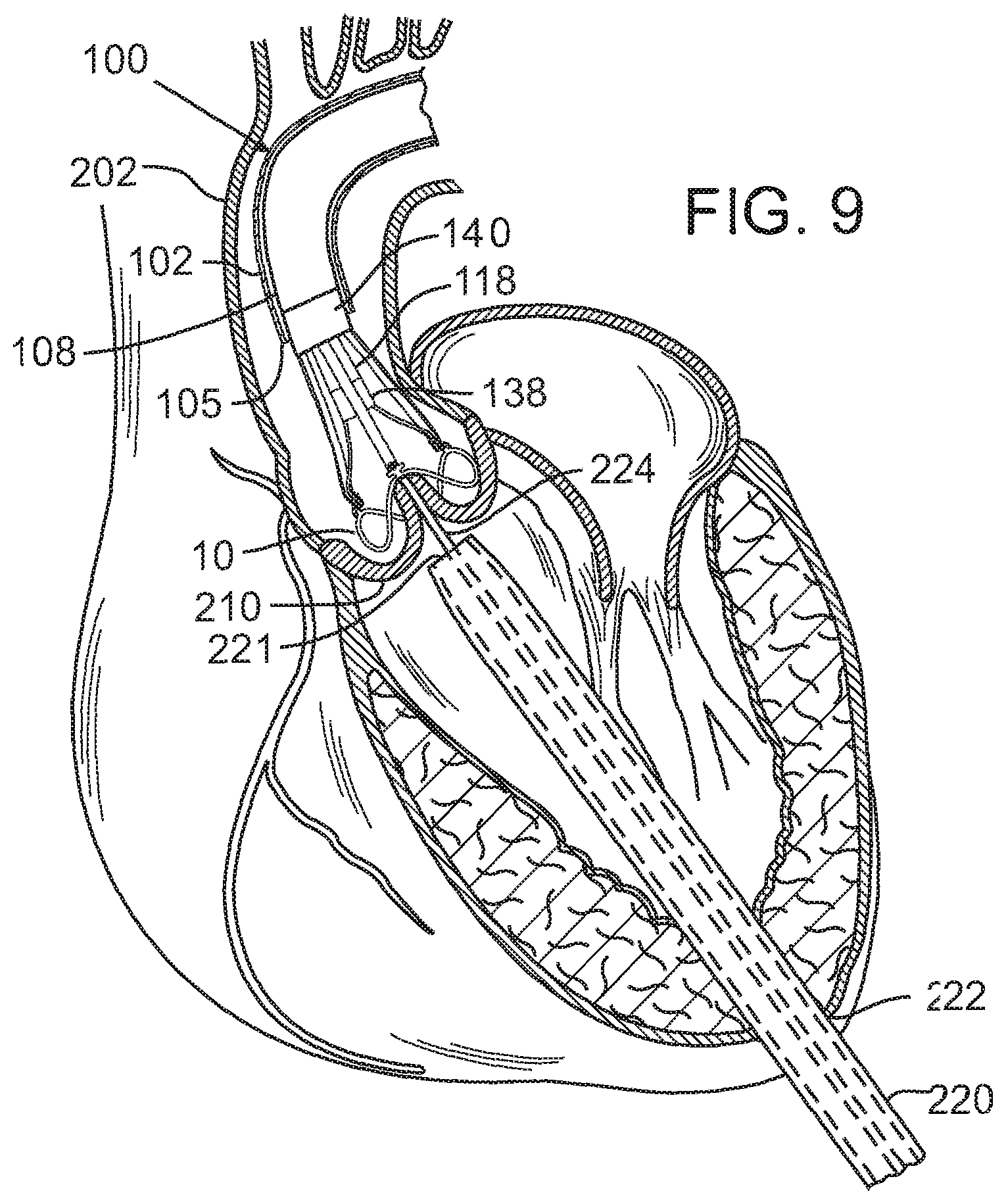 Patent US12090049 Figure 5 – Retaining mechanisms for prosthetic valves