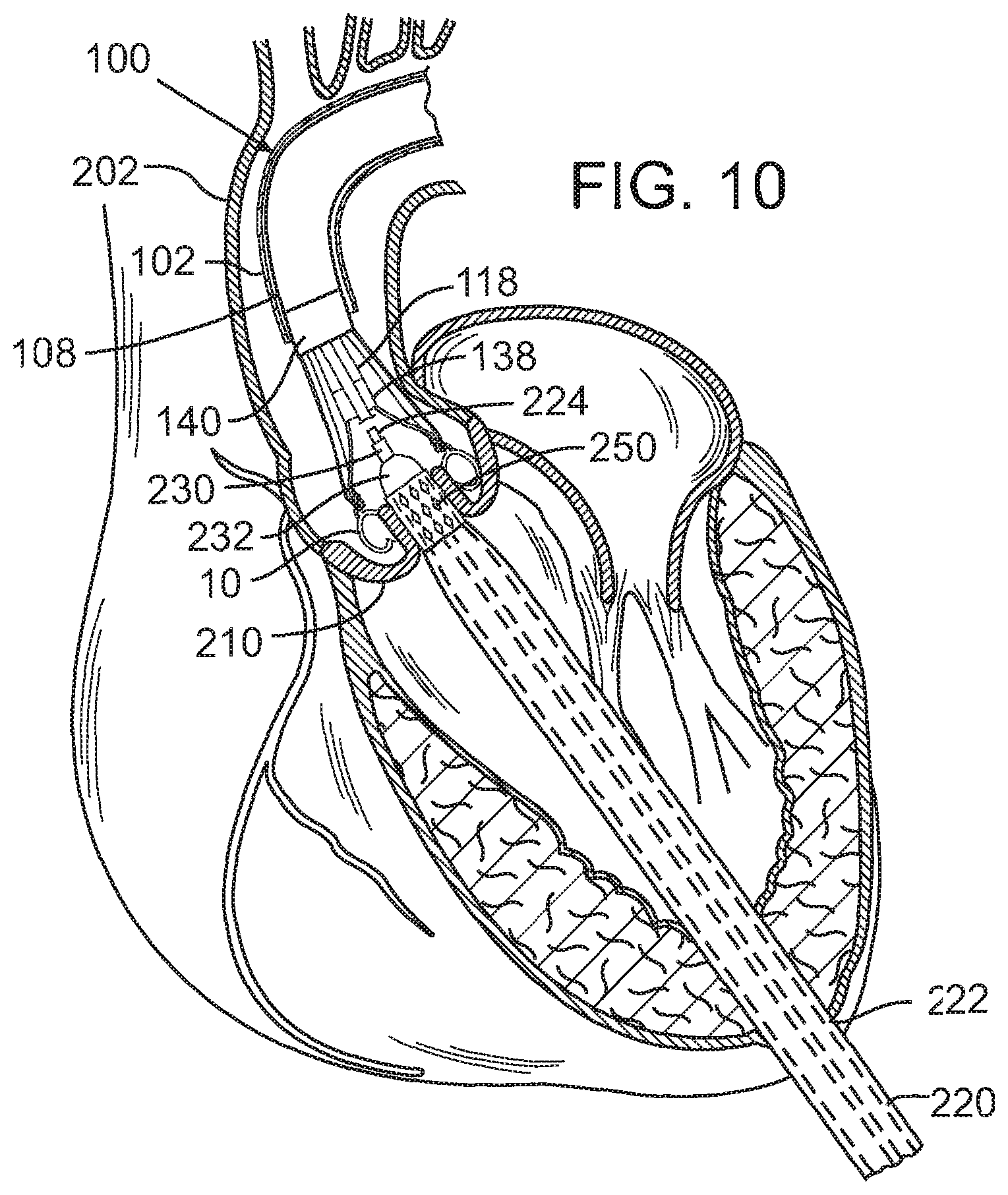 Patent US12090049 Figure 6 – Retaining mechanisms for prosthetic valves